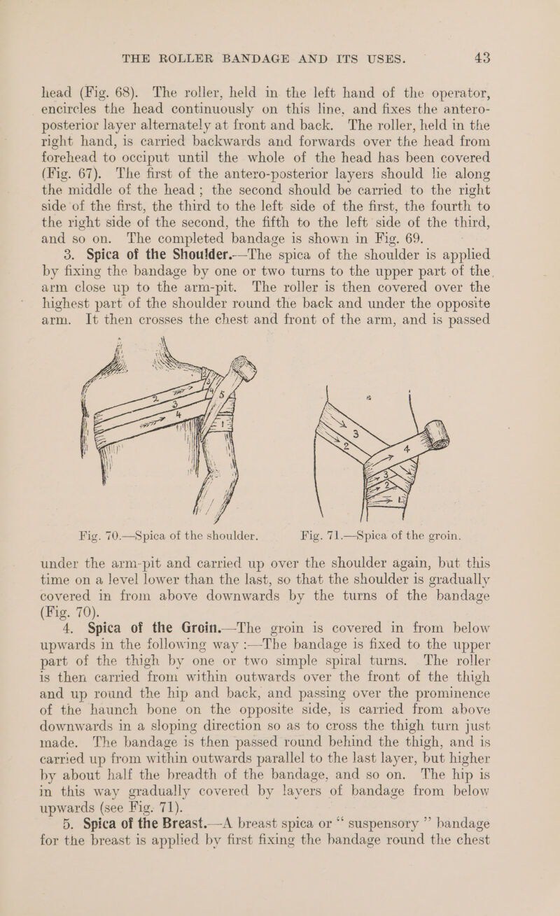 head (Fig. 68). The roller, held in the left hand of the operator, encircles the head continuously on this line, and fixes the antero- posterior layer alternately at front and back. The roller, held in the right hand, is carried backwards and forwards over the head from forehead to occiput until the whole of the head has been covered (Fig. 67). The first of the antero-posterior layers should he along the middle of the head; the second should be carried to the right side of the first, the third to the left side of the first, the fourth to the right side of the second, the fifth to the left side of the third, and so on. The completed bandage is shown in Fig. 69. } 3. Spica of the Shoulder.—The spica of the shoulder is applied by fixing the bandage by one or two turns to the upper part of the. arm close up to the arm-pit. The roller is then covered over the highest part of the shoulder round the back and under the opposite arm. It then crosses the chest and front of the arm, and is passed Fig. 70.—Spica of the shoulder. Fig. 71.—Spica of the groin. under the arm-pit and carried up over the shoulder again, but this time on a level lower than the last, so that the shoulder 1s gradually covered in from above downwards by the turns of the bandage (Fig. 70). 4. Spica of the Groin.—The eroin is covered in from below upwards in the following way :—The bandage is fixed to the upper part of the thigh by one or two simple spiral turns. The roller is then carried from within outwards over the front of the thigh and up round the hip and back, and passing over the prominence of the haunch bone on the opposite side, is carried from above downwards in a sloping direction so as to cross the thigh turn just made. The bandage is then passed round behind the thigh, and is carried up from within outwards parallel to the last layer, but higher by about half the breadth of the bandage, and so on. The hip is in this way gradually covered by layers of bandage from below upwards (see Fig. 71). | 5. Spica of the Breast.—A breast spica or “ suspensory ” bandage for the breast is applied by first fixing the bandage round the chest