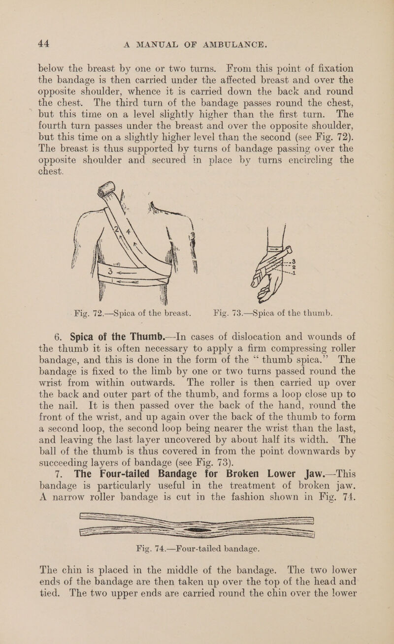 below the breast by one or two turns. From this point of fixation the bandage is then carried under the affected breast and over the opposite shoulder, whence it is carried down the back and round the chest. The third turn of the bandage passes round the chest, ~ but this time on a level slightly higher than the first turn. The fourth turn passes under the breast and over the opposite shoulder, but this time on a slightly higher level than the second (see Fig. 72). The breast 1s thus supported by turns of bandage passing over the opposite shoulder and secured in place by turns encircling the chest. 6. Spica of the Thumb.—In cases of dislocation and wounds of the thumb it is often necessary to apply a firm compressing roller bandage, and this is done in the form of the “thumb spica.” The bandage is fixed to the limb by one or two turns passed round the wrist from within outwards. The roller is then carried up over the back and outer part of the thumb, and forms a loop close up to the nail. It is then passed over the back of the hand, round the front of the wrist, and up again over the back of the thumb to form a second loop, the second loop being nearer the wrist than the last, and leaving the last layer uncovered by about half its width. The ball of the thumb is thus covered in from the point downwards by succeeding layers of bandage (see Vig. 73). 7. The Four-tailed Bandage for Broken Lower Jaw.—This bandage is particularly useful in the treatment of broken jaw. A narrow roller bandage is cut in the fashion shown in Fig. 74. The chin is placed in the middle of the bandage. The two lower ends of the bandage are then taken up over the top of the head and tied. The two upper ends are carried round the chin over the lower