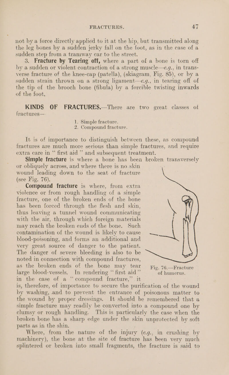 not by a force directly applied to it at the lip, but transmitted along the leg bones by a sudden jerky fall on the foot, as in the case of a sudden step from a tramway car to the street. 3. Fracture by Tearing off, where a part of a bone is torn off by a sudden or violent contraction of a ie muscle—e.g., In trans- verse fracture of the knee-cap (patella), (skiagram, Fig. 85), or by a sudden strain thrown on a strong licament—e.g g-, in tearing off of the tip of the brooch bone (fibula) by a forcible twisting inwards of the foot. KINDS OF FRACTURES.— There are two great classes of fractures—: 1. Simple fracture. 2. Compound fracture. It is of importance to distinguish between these, as compound fractures are much more serious than simple fractures, and require extra care in “ first aid’ and subsequent treatment. Simple fracture is where a bone has been broken transversely or obliquely across, and where there is no skin wound jeading down to the seat of fracture (see Fig. 76). Compound fracture is where, from extra violence or from rough handling of a simple fracture, one of the broken ends of the bone has been forced through the flesh and skin, thus leaving a tunnel wound communicating with the air, through which foreign materials may reach the broken ends of the bone. Such contamination of the wound is likely to cause blood-poisoning, and forms an additional and very great source of danger to the patient. The danger of severe bleeding ts also to be noted in connection with compound fractures, as the broken ends of the bone may tear fico 76 Fracture Jarge blood-vessels. In rendering “ first aid”’ “of humerus. in the case of a “compound fracture,” it is, therefore, of importance to secure the purification of the wound by washing, and to prevent the entrance of poisonous matter to the wound by proper dressings. It should be remembered that a simple fracture may readily be converted into a compound one by clumsy or rough handling. This is particularly the case when the broken bone has a sharp edge under the skin unprotected by soft parts as in the shin. Where, from the nature of the injury (eg., in crushing by machinery), the bone at the site of fracture has been very much splintered or broken into small fragments, the fracture is said to
