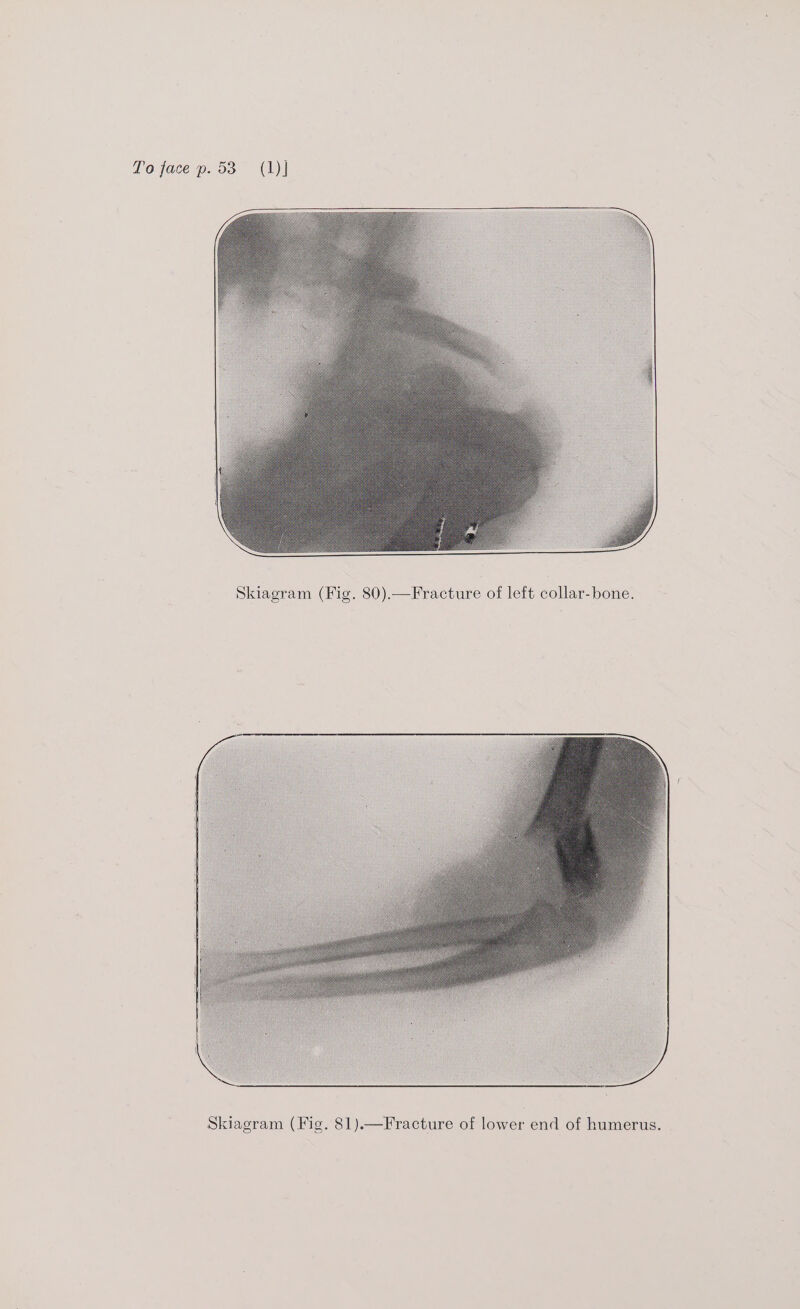 Skiagram (Fig. 80).—Fracture of left collar-bone. WS Skiagram (Fig. 81).—Fracture of lower end of humerus.