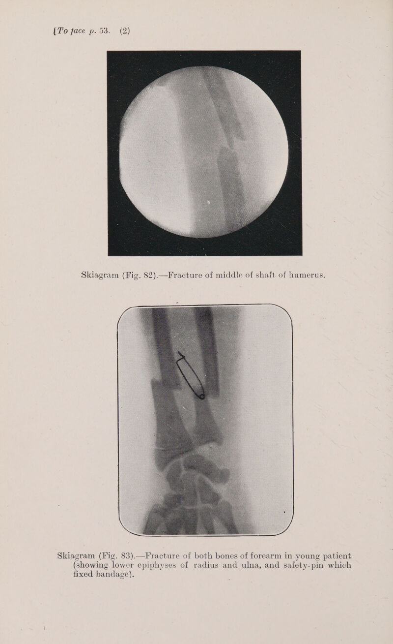 Skiagram (Fig. 83).—Fracture of both bones of forearm in young patient (showing lower epiphyses of radius and ulna, and safety-pin which fixed bandage).