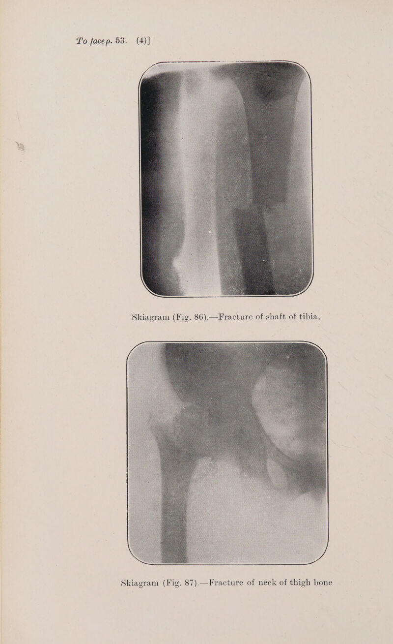 Skiagram (Fi . 87).—Fracture of neck of thigh bone