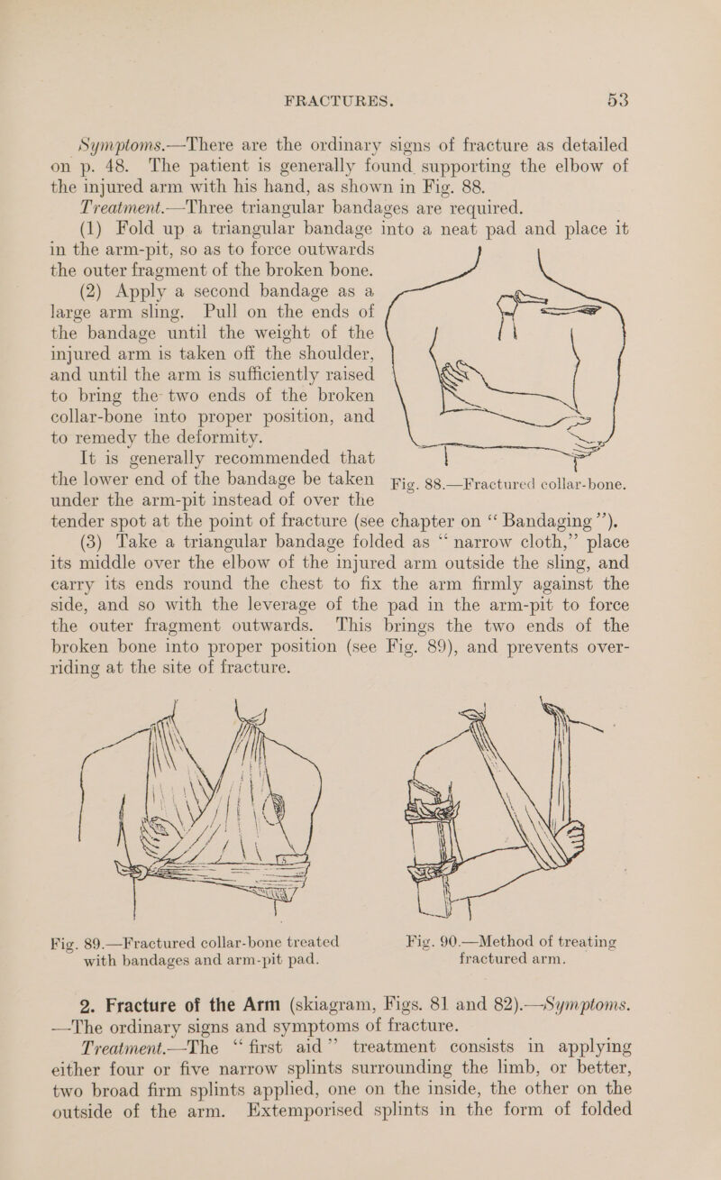 Symptoms.—There are the ordinary siens of fracture as detailed on p. 48. The patient is generally found supporting the elbow of the injured arm with his hand, as shown in Fig. 88. Treatment.—Three triangular bandages are required. (1) Fold up a triangular bandage into a neat pad and place it in the arm-pit, so as to force outwards the outer fragment of the broken bone. (2) Apply a second bandage as a large arm sling. Pull on the ends of the bandage until the weight of the injured arm is taken off the shoulder, and until the arm is sufficiently raised to bring the two ends of the broken collar-bone into proper position, and to remedy the deformity. It is generally recommended that the lower end of the bandage be taken under the arm-pit instead of over the tender spot at the point of fracture (see chapter on ‘“‘ Bandaging”’), (3) Take a triangular bandage folded as “ narrow cloth,” place its middle over the elbow of the injured arm outside the sling, and carry its ends round the chest to fix the arm firmly against the side, and so with the leverage of the pad in the arm-pit to force the outer fragment outwards. This brings the two ends of the broken bone into proper position (see Fig. 89), and prevents over- riding at the site of fracture. Fig. 88.—Fractured collar-bone. Fig. 89.—Fractured collar-bone treated Fig. 90.—Method of treating with bandages and arm-pit pad. fractured arm. 2. Fracture of the Arm (skiagram, Figs. 81 and 82).—Symptoms. —The ordinary signs and symptoms of fracture. Treatment.—The “first aid” treatment consists in applying either four or five narrow splints surrounding the limb, or better, two broad firm splints applied, one on the inside, the other on the outside of the arm. Extemporised splints in the form of folded