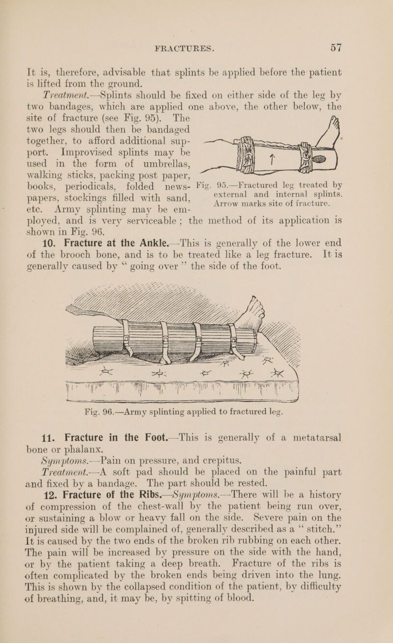 It is, therefore, advisable that splints be applied before the patient is lifted from the ground. Treatment.—Splints should be fixed on either side of the leg by two bandages, which are applied one above, the other below, the site of fracture (see Fig. 95). The two legs should then be bandaged together, to afford additional sup- port. Improvised splints may be used in the form of umbrellas, walking sticks, packing post paper, books, periodicals, folded news- Fig. 95.—Fractured leg treated by papers, stockings filled with sand, arias ee ae jae Arrow marks site of iracture. etc. Army splinting may be em- ployed, and is very serviceable ; the method of its application is shown in Fig. 96. 10. Fracture at the Ankle.—This is generally of the lower end of the brooch bone, and is to be treated like a leg fracture. It is generally caused by “ going over” the side of the foot. “\ a sitll : ty es = —— Vij == 7s — = a YY, “DY, IF 4a a ae \ it y | z yy \ 11. Fracture in the Foot.—This is generally of a metatarsal bone or phalanx. Symptoms.—Pain on pressure, and crepitus. Treatment.—A soft pad should be placed on the painful part and fixed by a bandage. The part should be rested. 12. Fracture of the Ribs.—Symptoms.—There will be a history of compression of the chest-wall by the patient being run over, or sustaining a blow or heavy fall on the side. Severe pain on the injured side will be complained of, generally described as a “ stitch.” It is caused by the two ends of the broken rib rubbing on each other. The pain will be increased by pressure on the side with the hand, or by the patient taking a deep breath. Fracture of the ribs is often complicated by the broken ends being driven into the lung. This is shown by the collapsed condition of the patient, by difficulty of breathing, and, it may be, by spitting of blood. |