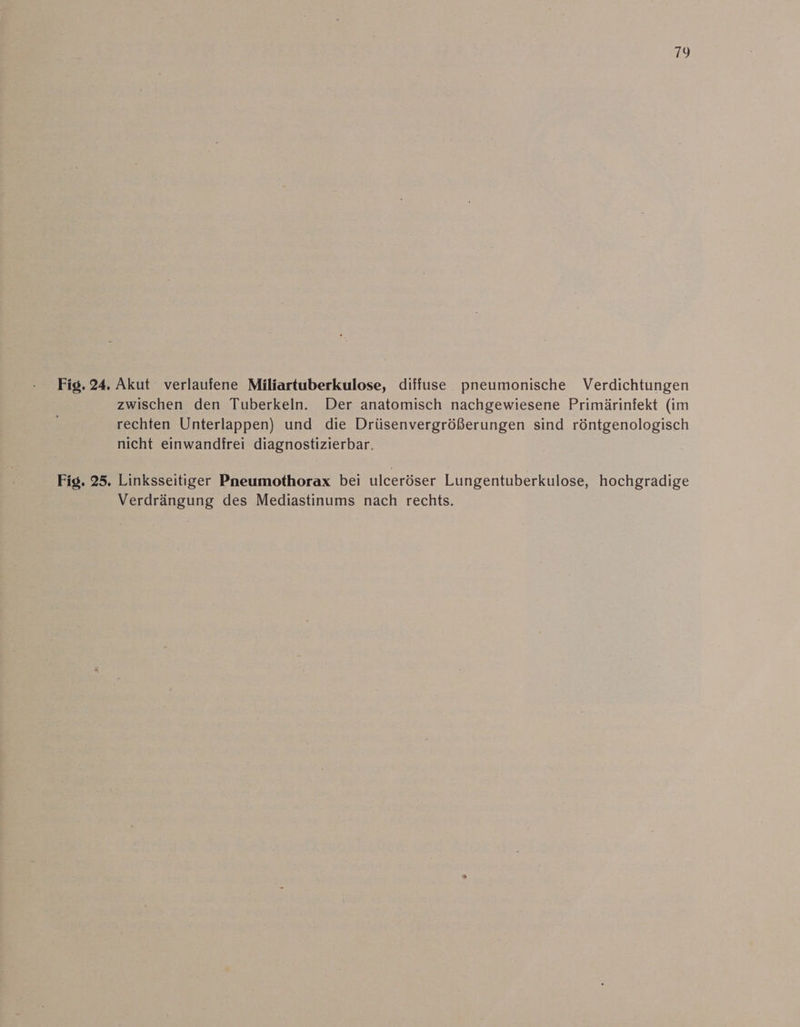 179 Fig. 24. Akut verlaufene Miliartuberkulose, diffuse pneumonische Verdichtungen zwischen den Tuberkeln. Der anatomisch nachgewiesene Primärinfekt (im rechten Unterlappen) und die Drüsenvergrößerungen sind röntgenologisch nicht einwandfrei diagnostizierbar. Fig. 25. Linksseitiger Pneumothorax bei ulceröser Lungentuberkulose, hochgradige Verdrängung des Mediastinums nach rechts.