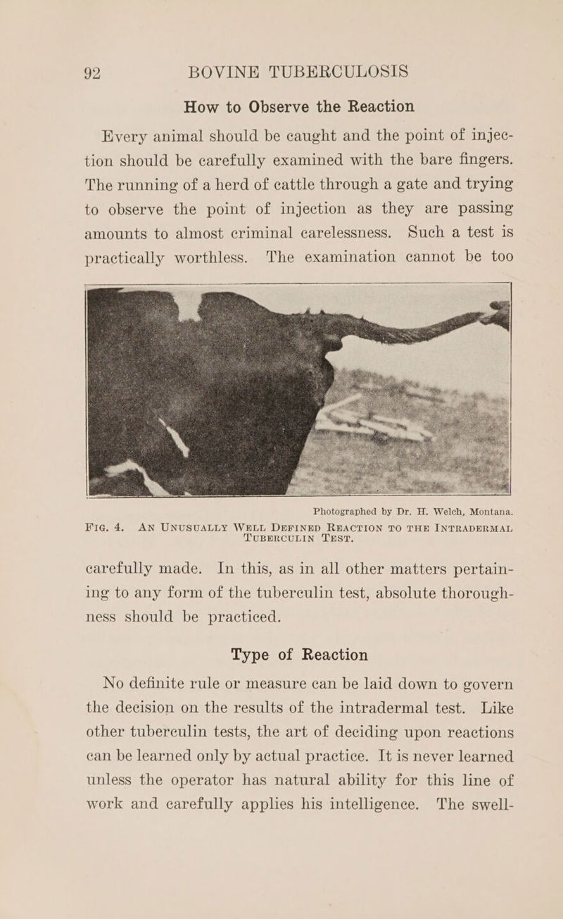 How to Observe the Reaction Every animal should be caught and the point of injec- tion should be carefully examined with the bare fingers. The running of a herd of cattle through a gate and trying to observe the point of injection as they are passing amounts to almost criminal carelessness. Such a test is practically worthless. The examination cannot be too Fie. 4. AN UNUSUALLY WELL DEFINED REACTION TO THE INTRADERMAL TUBERCULIN TEST. carefully made. In this, as in all other matters pertain- ing to any form of the tuberculin test, absolute thorough- ness should be practiced. Type of Reaction No definite rule or measure can be laid down to govern the decision on the results of the intradermal test. Like other tuberculin tests, the art of deciding upon reactions ean be learned only by actual practice. It is never learned unless the operator has natural ability for this line of work and carefully apples his intelligence. The swell-