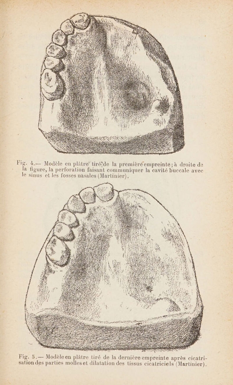 F LS 10° Le 3. 4.— Modèle en plâtre’ tiré*de la premièré empreinte; à droite de la figure, la perforation faisant communiquer la cavité buccale avec le sinus et les fosses nasales (Martinier), # +de | Fig. 5.— Modèle en plâtre tiré de la dernière empreinte après cicatri- sation des parties molleset dilatation des tissus cicatriciels (Martinier).