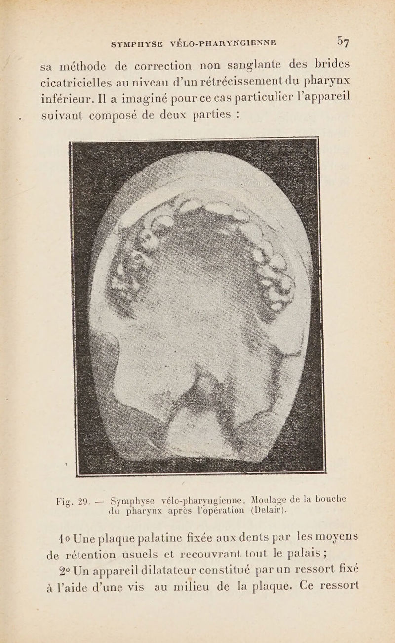 sa méthode de correction non sanglante des brides cicatricielles au niveau d’un rétrécissement du pharynx inférieur. Il a imaginé pour ce cas particulier l’appareil suivant composé de deux parties : Fig. 29, — Symphyse vélo-pharyngienne. Moulage de la bouche du pharynx après l'opération (Delair). 10 Une plaque palatine fixée aux dents par les moyens de rétention usuels et recouvrant tout le palais ; 20 Un appareil dilatateur constitué par un ressort fixé à l’aide d’une vis au milieu de la plaque. Ce ressort