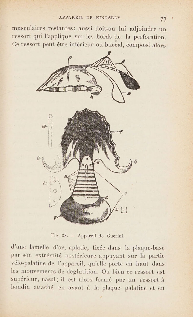 APPAREIL DE KINGSLEY 7/7) musculaires restantes; aussi doit-on lui adjoindre un ressort qui l’applique sur les bords de la perforation. Ce ressort peut être inférieur ou buccal, composé alors | Ÿ ‘1 T à = » ml À Mae mm ét Gras © ss PET EN d'une lamelle d’or, aplatie, fixée dans la plaque-base par son extrémité postérieure appuyant sur la partie vélo-palatine de lappareil, qu’elle porte en haut dans les mouvements de déglutition. Ou bien ce ressort est supérieur, nasal; il est alors formé par un ressort à boudin attaché en avant à la plaque palatine et en