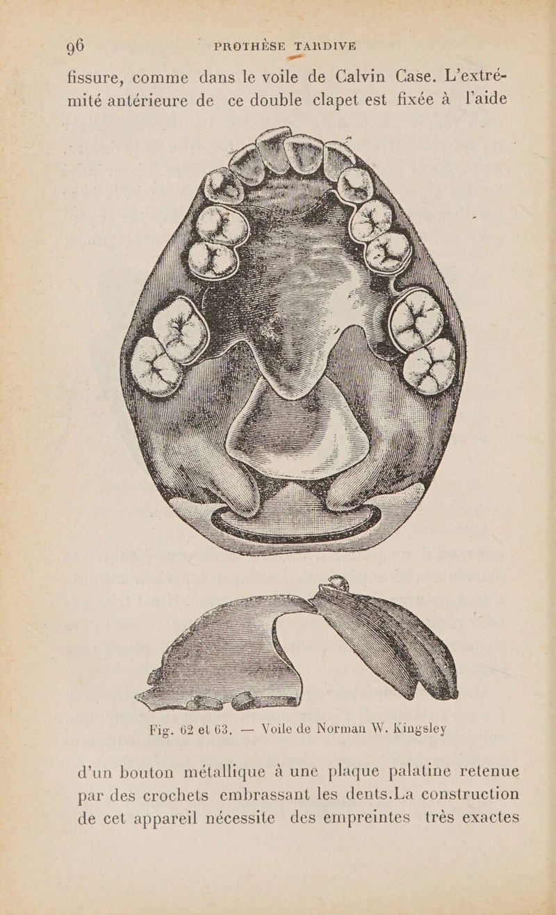 fissure, comme dans le voile de Calvin Case. L’extré- mité antérieure de ce double clapet est fixée à l’aide d'un bouton métallique à une plaque palatine retenue par des crochets embrassant les dents.La construction de cet appareil nécessite des empreintes très exactes
