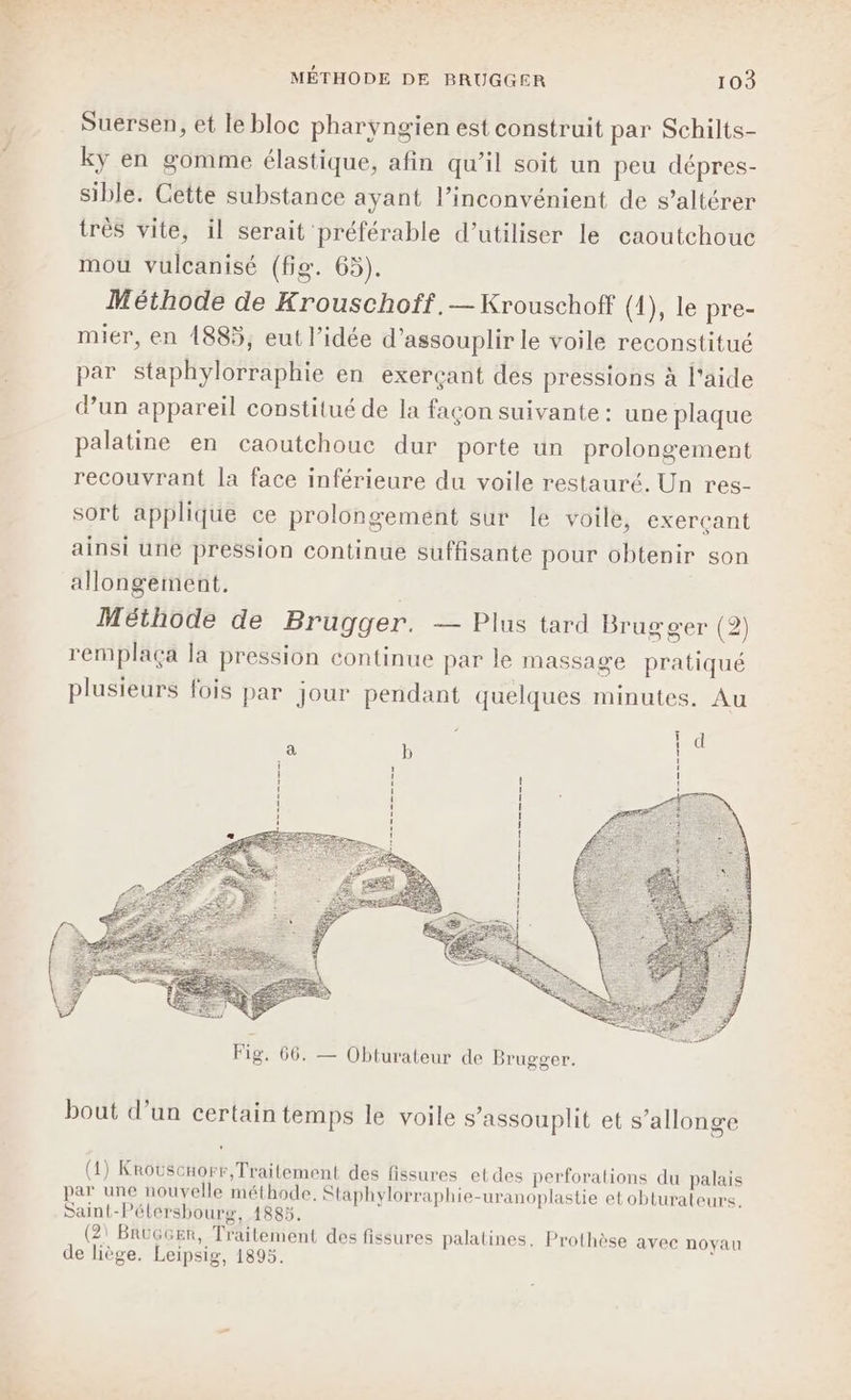 Suersen, et le bloc pharyngien est construit par Schilts- kÿy en gomme élastique, afin qu’il soit un peu dépres- sible. Cette substance ayant l'inconvénient de s’altérer très vite, il serait préférable d'utiliser le caoutchouc mou vulcanisé (fig. 65). Méthode de Krouschoff.— Krouschoff (1), le pre- mier, en 1885, eut l’idée d’assouplir le voile reconstitué par staphylorraphie en exerçant des pressions à l'aide d’un appareil constitué de la façon suivante: une plaque palatine en caoutchouc dur porte un prolongement recouvrant la face inférieure du voile restauré, Un res- sort applique ce prolongement sur le voile, exerçant ainsi une pression continue suffisante pour obtenir son allongement,. Méthode de Brugger. — Plus tard Brugger (2) remplaça la pression continue par le massage pratiqué plusieurs fois par jour pendant quelques minutes. Au = 5 : | PE EN Fig. 66. — Obturateur de Brugger. bout d’un certain temps le voile s’assouplit et s’allonge (1) Krouscmorr, Traitement des fissures etdes perforations du palais par une nouvelle méthode, Staphylorraphie-uranoplastie et obturateurs. Saint-Pélersbourg, 1885. (2) Brüccer, Traitement des fissures palatines. Prothèse avec novau de liège. Leipsig, 1895.