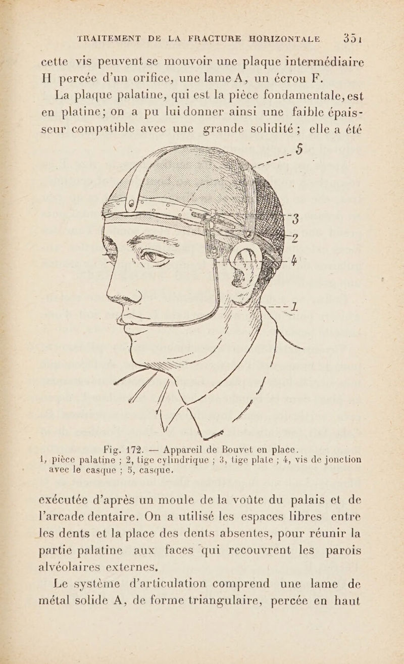 cette vis peuvent se mouvoir une plaque intermédiaire H percée d’un orifice, une lame À, un écrou F. La plaque palatine, qui est la pièce fondamentale, est en platine; on a pu lui donner ainsi une faible épais- seur compatible avec une grande solidité; elle a été ee ; Fig. 172. — Appareil de Bouvet en place. 1, pièce palatine ; 2, tige cylindrique ; 3, tige plate ; 4, vis de jonction avec le casque ; 5, casque, exécutée d’après un moule de la voûte du palais et de l’arcade dentaire. On a utilisé les espaces libres entre les dents et la place des dents absentes, pour réunir la partie palatine aux faces qui recouvrent les parois alvéolaires externes, Le système d’articulation comprend une lame de métal solide A, de forme triangulaire, percée en haut