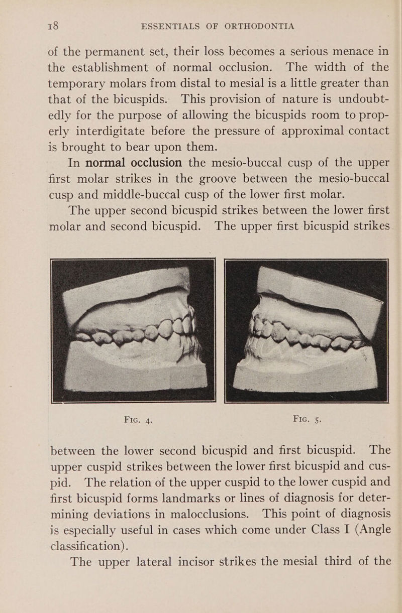 of the permanent set, their loss becomes a serious menace in the establishment of normal occlusion. The width of the temporary molars from distal to mesial is a little greater than that of the bicuspids. This provision of nature is undoubt- edly for the purpose of allowing the bicuspids room to prop- erly interdigitate before the pressure of approximal contact is brought to bear upon them. In normal occlusion the mesio-buccal cusp of the upper first molar strikes in the groove between the mesio-buccal cusp and middle-buccal cusp of the lower first molar. The upper second bicuspid strikes between the Jower first molar and second bicuspid. The upper first bicuspid strikes between the lower second bicuspid and first bicuspid. The upper cuspid strikes between the lower first bicuspid and cus- pid. The relation of the upper cuspid to the lower cuspid and first bicuspid forms landmarks or lines of diagnosis for deter- mining deviations in malocclusions. This point of diagnosis is especially useful in cases which come under Class I (Angle classification). The upper lateral incisor strikes the mesial third of the