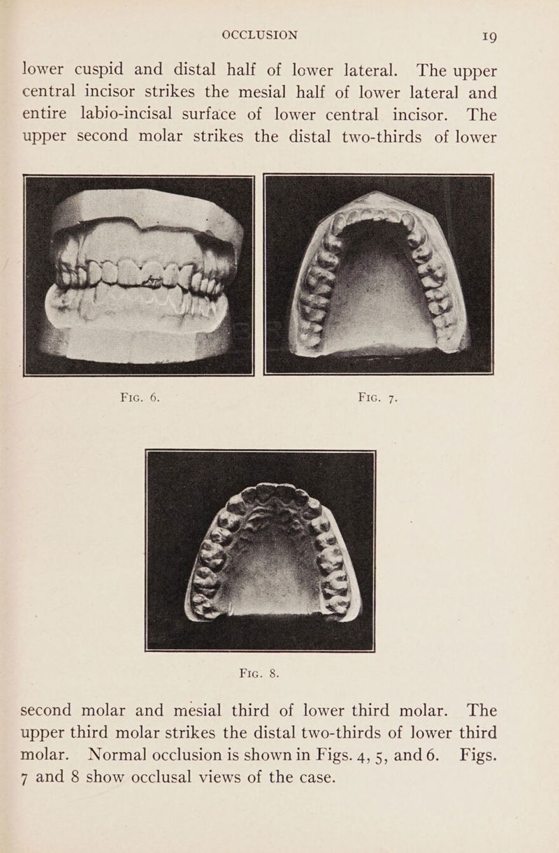 lower cuspid and distal half of lower lateral. The upper central incisor strikes the mesial half of lower lateral and entire labijo-incisal surface of lower central incisor. The upper second molar strikes the distal two-thirds of lower iGO. Fic. 7. second molar and mesial third of lower third molar. The upper third molar strikes the distal two-thirds of lower third molar. Normal occlusion is shown in Figs. 4,5, and6. Figs. 7 and 8 show occlusal views of the case.