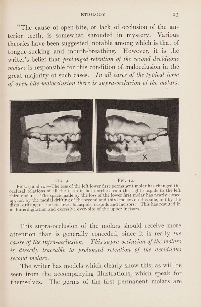 “The cause of open-bite, or lack of occlusion of the an- terior teeth, is somewhat shrouded in mystery. Various theories have been suggested, notable among which is that of tongue-sucking and mouth-breathing. However, it is the writer’s belief that prolonged retention of the second deciduous molars is responsible for this condition of malocclusion in the great majority of such cases. Jn all cases of the typical form of open-bite malocclusion there is supra-occlusion of the molars. This supra-occlusion of the molars should receive more attention than is generally conceded, since it is really the cause of the infra-occlusion. This supra-occlusion of the molars is directly traceable to prolonged retention of the deciduous second molars. The writer has models which clearly show this, as will be seen from the accompanying illustrations, which speak for themselves. The germs of the first permanent molars are