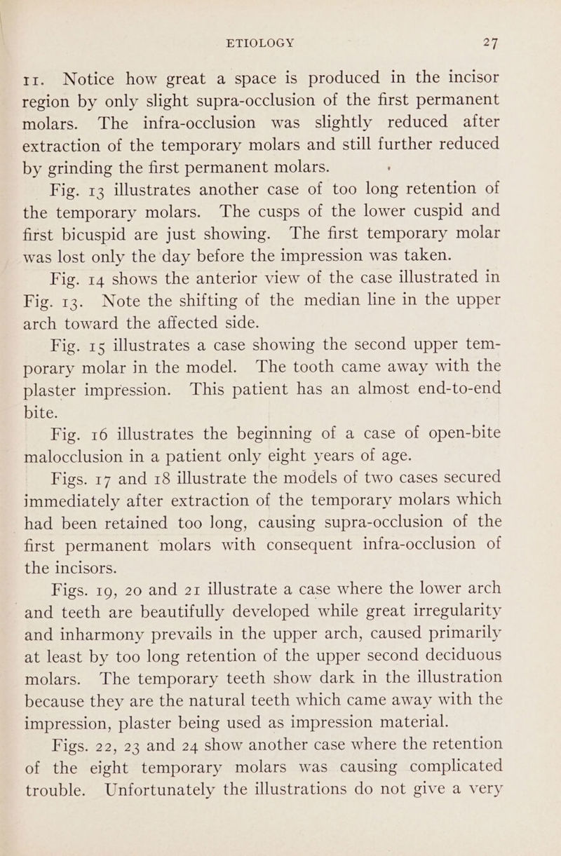 t1. Notice how great a space is produced in the incisor region by only slight supra-occlusion of the first permanent molars. The infra-occlusion was slightly reduced after extraction of the temporary molars and still further reduced by grinding the first permanent molars. Fig. 13 illustrates another case of too long retention of the temporary molars. The cusps of the lower cuspid and first bicuspid are just showing. The first temporary molar was lost only the day before the impression was taken. Fig. 14 shows the anterior view of the case illustrated in Fig. 13. Note the shifting of the median line in the upper arch toward the affected side. Fig. 15 illustrates a case showing the second upper tem- porary molar in the model. The tooth came away with the plaster impression. This patient has an almost end-to-end bite. | Fig. 16 illustrates the beginning of a case of open-bite malocclusion in a patient only eight years of age. Figs. 17 and 18 illustrate the models of two cases secured immediately after extraction of the temporary molars which had been retained too long, causing supra-occlusion of the first permanent molars with consequent infra-occlusion of the incisors. Figs. 19, 20 and 21 illustrate a case where the lower arch and teeth are beautifully developed while great irregularity and inharmony prevails in the upper arch, caused primarily at least by too long retention of the upper second deciduous molars. The temporary teeth show dark in the illustration because they are the natural teeth which came away with the impression, plaster being used as impression material. Figs. 22, 23 and 24 show another case where the retention of the eight temporary molars was causing complicated trouble. Unfortunately the illustrations do not give a very