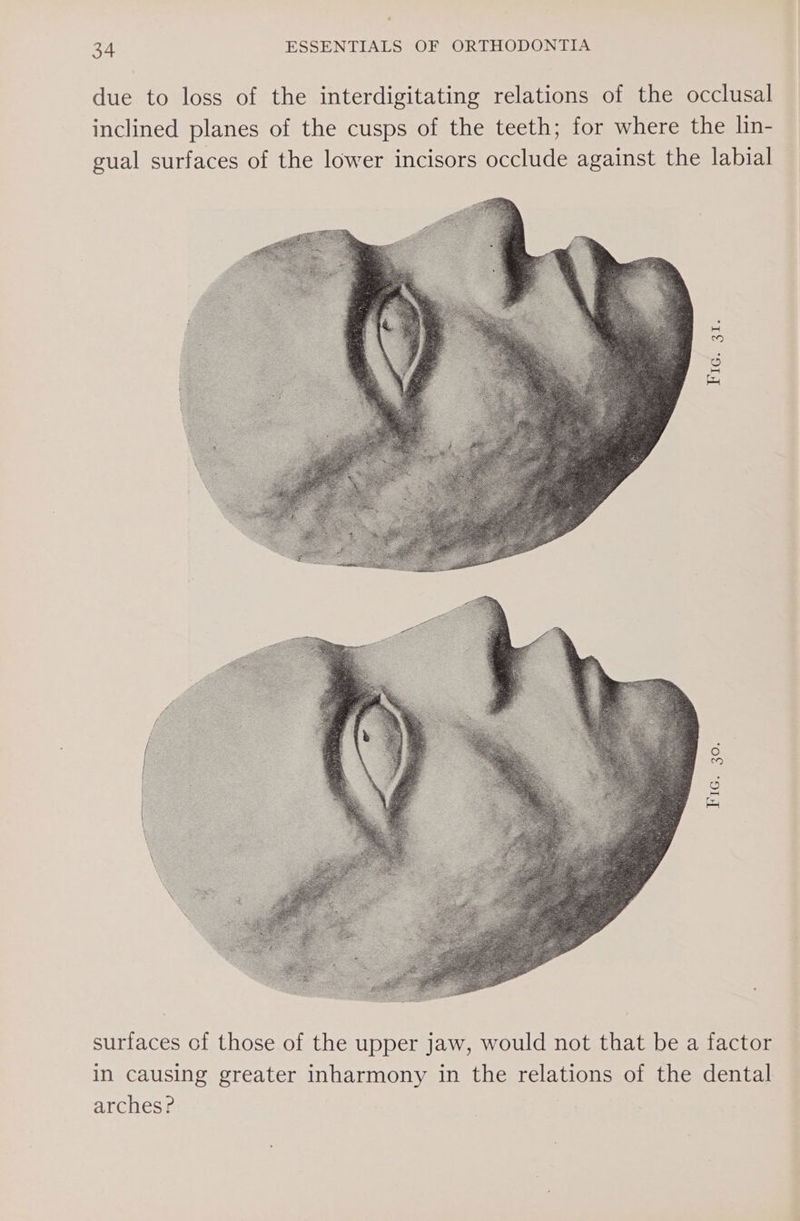 due to loss of the interdigitating relations of the occlusal inclined planes of the cusps of the teeth; for where the lin- gual surfaces of the lower incisors occlude against the labial Figteate IG 30; surfaces of those of the upper jaw, would not that be a factor in causing greater inharmony in the relations of the dental arches?