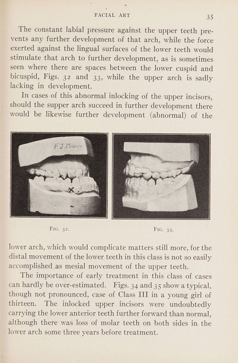 The constant labial pressure against the upper teeth pre- vents any further development of that arch, while the force exerted against the lingual surfaces of the lower teeth would stimulate that arch to further development, as is sometimes seen where there are spaces between the lower cuspid and bicuspid, Figs. 32 and 33, while the upper arch is sadly lacking in development. In cases of this abnormal inlocking of the upper incisors, should the supper arch succeed in further development there would be likewise further development (abnormal) of the HIG eso, FIG. 33. lower arch, which would complicate matters still more, for the distal movement of the lower teeth in this class is not so easily accomplished as mesial movement of the upper teeth. The importance of early treatment in this class of cases can hardly be over-estimated. Figs. 34 and 35 show a typical, though not pronounced, case of Class III in a young girl of thirteen. The inlocked upper incisors were undoubtedly carrying the lower anterior teeth further forward than normal, although there was loss of molar teeth on both sides in the lower arch some three years before treatment.