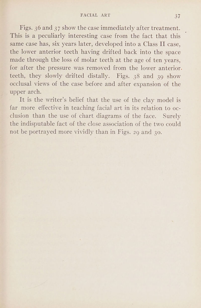 Figs. 36 and 37 show the case immediately after treatment. This is a peculiarly interesting case from the fact that this same case has, six years later, developed into a Class II case, the lower anterior teeth having drifted back into the space made through the loss of molar teeth at the age of ten years, for after the pressure was removed from the lower anterior. teeth, they slowly drifted distally. Figs. 38 and 39 show occlusal views of the case before and after expansion of the upper arch. It is the writer’s belief that the use of the clay model is far more effective in teaching facial art in its relation to oc- clusion than the use of chart diagrams of the face. Surely the indisputable fact of the close association of the two could not be portrayed more vividly than in Figs. 29 and 30.