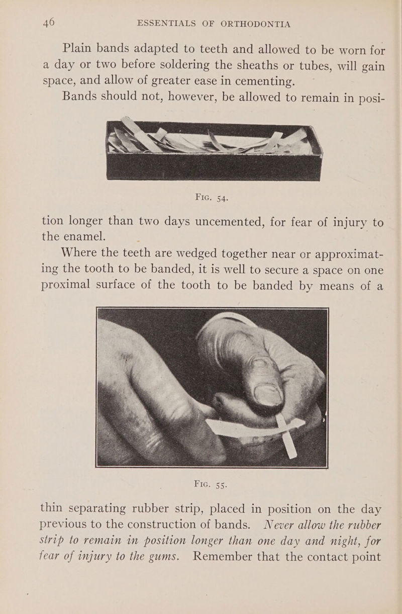 Plain bands adapted to teeth and allowed to be worn for a day or two before soldering the sheaths or tubes, will gain space, and allow of greater ease in cementing. Bands should not, however, be allowed to remain in posi- Fic. Sa. tion longer than two days uncemented, for fear of injury to the enamel. : | Where the teeth are wedged together near or approximat- ing the tooth to be banded, it is well to secure a space on one proximal surface of the tooth to be banded by means of a thin separating rubber strip, placed in position on the day previous to the construction of bands. Never allow the rubber strip to remain in position longer than one day and night, for fear of injury to the gums. Remember that the contact point