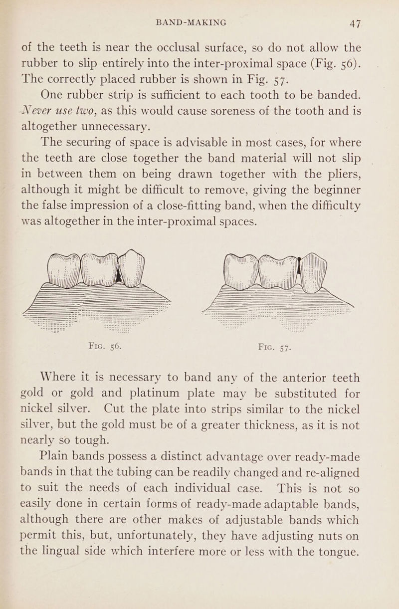 of the teeth is near the occlusal surface, so do not allow the rubber to slip entirely into the inter-proximal space (Fig. 56). The correctly placed rubber is shown in Fig. 57. One rubber strip is sufficient to each tooth to be banded. Never use two, as this would cause soreness of the tooth and is altogether unnecessary. | The securing of space is advisable in most cases, for where the teeth are close together the band material will not slip in between them on being drawn together with the pliers, although it might be difficult to remove, giving the beginner the false impression of a close-fitting band, when the difficulty was altogether in the inter-proximal spaces. | Where it is necessary to band any of the anterior teeth gold or gold and platinum plate may be substituted for nickel silver. Cut the plate into strips similar to the nickel silver, but the gold must be of a greater thickness, as it is not nearly so tough. Plain bands possess a distinct advantage over ready-made bands in that the tubing can be readily changed and re-aligned to suit the needs of each individual case. This is not so easily done in certain forms of ready-made adaptable bands, although there are other makes of adjustable bands which permit this, but, unfortunately, they have adjusting nuts on the lingual side which interfere more or less with the tongue.