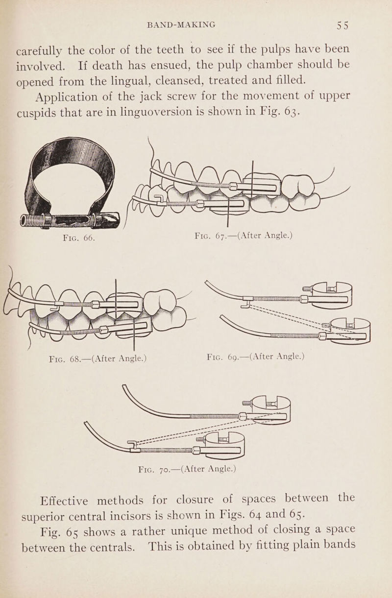 &lt;a . Cae i | £ . | ? Tr “AN ( iN yy &lt;\ Dye bins Al q Fic. 68.—(After Angle.) Effective methods for closure of spaces between the superior central incisors is shown in Figs. 64 and 65. Fig. 65 shows a rather unique method of closing a space between the centrals. This is obtained by fitting plain bands