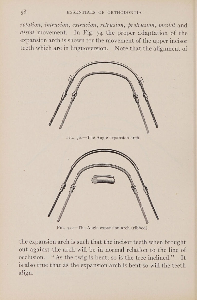 rotation, intrusion, extrusion, retrusion, protrusion, mesial and distal movement. In Fig. 74 the proper adaptation of the expansion arch is shown for the movement of the upper incisor teeth which are in linguoversion. Note that the alignment of the expansion arch is such that the incisor teeth when brought out against the arch will be in normal relation-to the line of occlusion. ‘“‘As the twig is bent, so is the tree inclined.” It is also true that as the expansion arch is bent so will the teeth align.