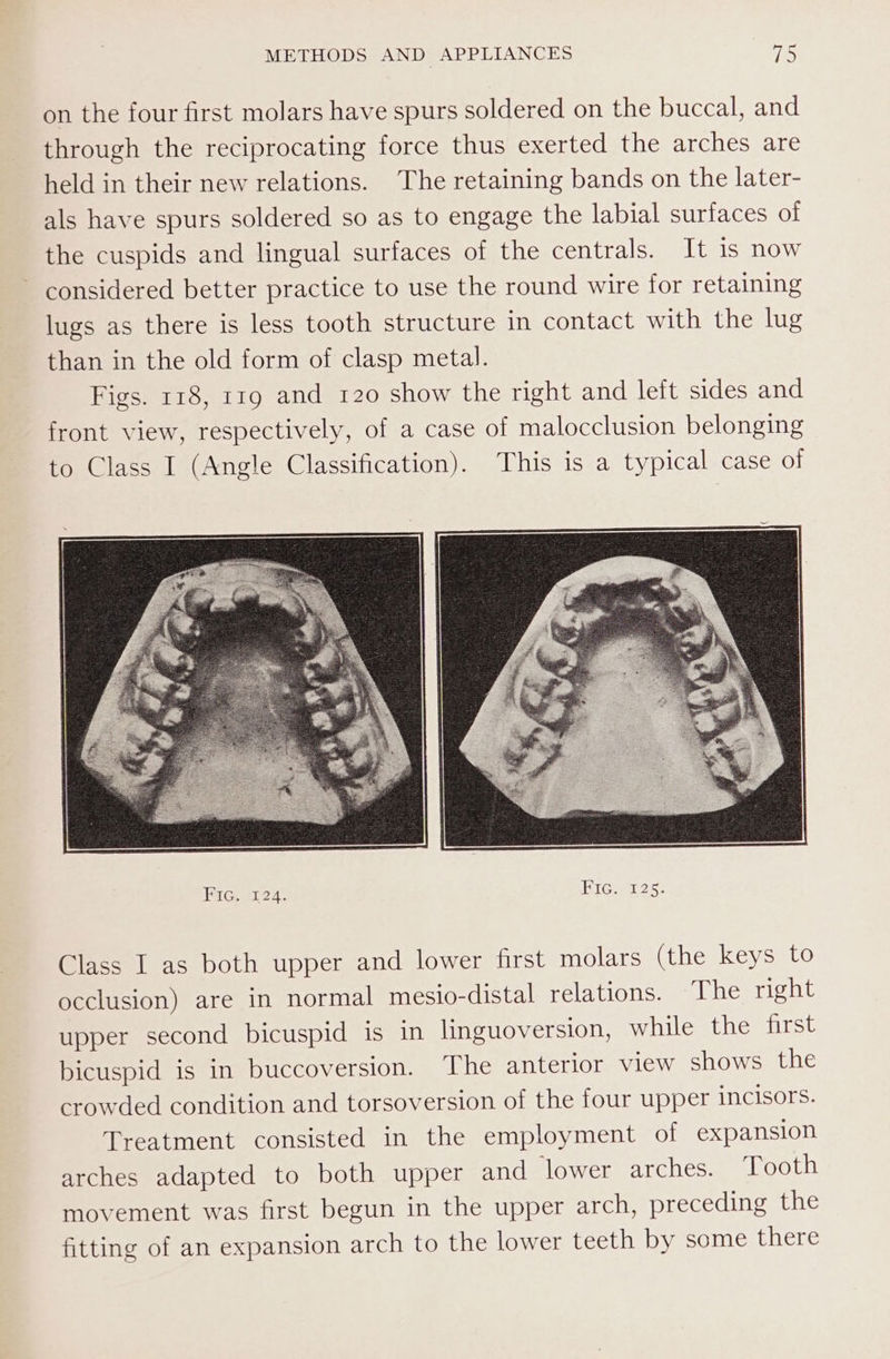 on the four first molars have spurs soldered on the buccal, and through the reciprocating force thus exerted the arches are held in their new relations. The retaining bands on the later- als have spurs soldered so as to engage the labial surfaces of the cuspids and lingual surfaces of the centrals. It is now considered better practice to use the round wire for retaining lugs as there is less tooth structure in contact with the lug than in the old form of clasp metal. Figs. 118, rrg and 120 show the right and left sides and front view, respectively, of a case of malocclusion belonging to Class I (Angle Classification). This is a typical case of Fire, 1124. HIG} 225: Class I as both upper and lower first molars (the keys to occlusion) are in normal mesio-distal relations. The right upper second bicuspid is in linguoversion, while the first bicuspid is in buccoversion. ‘The anterior view shows the crowded condition and torsoversion of the four upper incisors. Treatment consisted in the employment of expansion arches adapted to both upper and ‘lower arches. ‘Tooth movement was first begun in the upper arch, preceding the fitting of an expansion arch to the lower teeth by some there