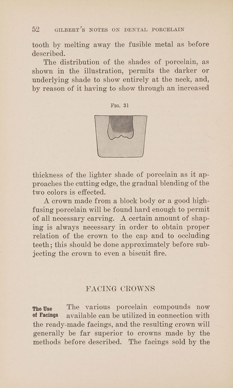 tooth by melting away the fusible metal as before described. The distribution of the shades of porcelain, as shown in the illustration, permits the darker or underlying shade to show entirely at the neck, and, by reason of it having to show through an increased thickness of the lighter shade of porcelain as it ap- proaches the cutting edge, the gradual blending of the two colors is effected. A crown made from a block body or a good high- fusing porcelain will be found hard enough to permit of all necessary carving. A certain amount of shap- ing is always necessary in order to obtain proper relation of the crown to the cap and to occluding teeth; this should be done approximately before sub- jecting the crown to even a biscuit fire. FACING CROWNS The Use The various porcelain compounds now of Facings available can be utilized in connection with the ready-made facings, and the resulting crown will generally be far superior to crowns made by the methods before described. The facings sold by the