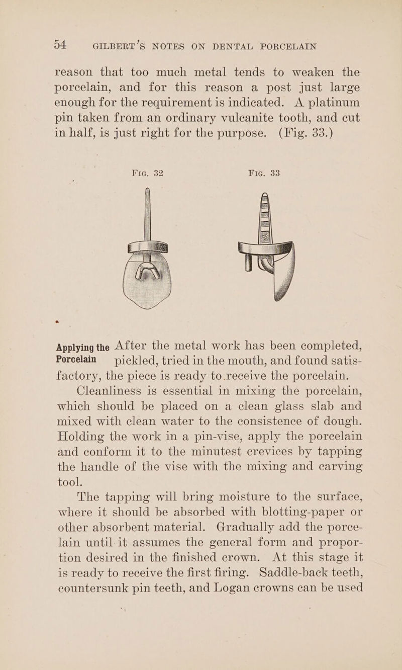 reason that too much metal tends to weaken the porcelain, and for this reason a post just large enough for the requirement is indicated. A platinum pin taken from an ordinary vuleanite tooth, and cut in half, is just right for the purpose. (Fig. 33.) Applying the After the metal work has been completed, Porcelain = pickled, tried in the mouth, and found satis- factory, the piece is ready to.receive the porcelain. Cleanliness is essential in mixing the porcelain, which should be placed on a clean glass slab and mixed with clean water to the consistence of dough. Holding the work in a pin-vise, apply the porcelain and conform it to the minutest crevices by tapping the handle of the vise with the mixing and carving tool. The tapping will bring moisture to the surface, where it should be absorbed with blotting-paper or other absorbent material. Gradually add the porce- lain until-it assumes the general form and propor- tion desired in the finished crown. At this stage it is ready to receive the first firmg. Saddle-back teeth, countersunk pin teeth, and Logan crowns can be used