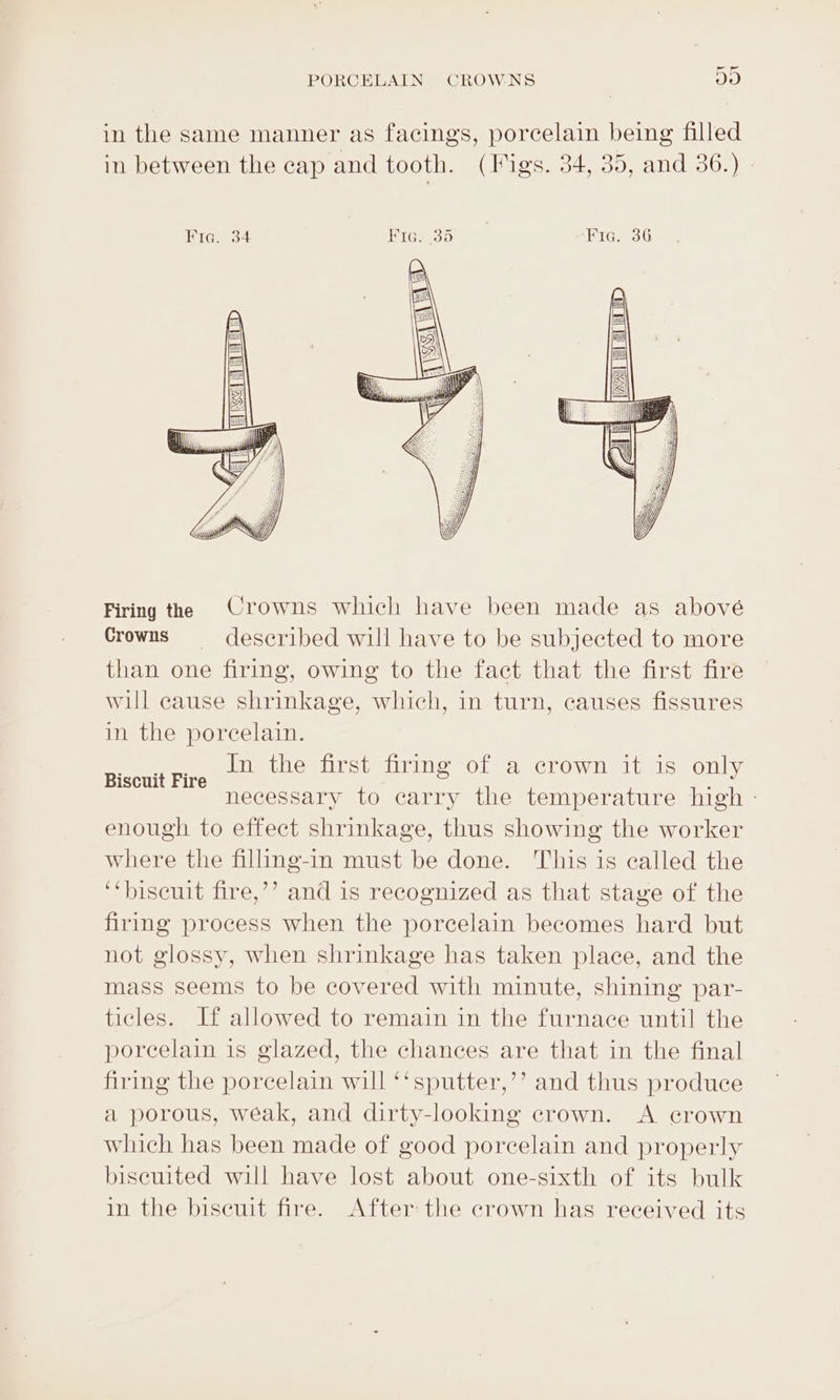 in the same manner as facings, porcelain being filled in between the cap and tooth. (Migs. 34, 35, and 36.) Firing the Crowns which have been made as abové Crowns deseribed will have to be subjected to more than one e firing, owing to the fact that the first fire will cause shrinkage, which, in turn, causes fissures in the porcelain. nPLhee rst OMOl fie CLOW lie lis only necessary to carry the temperature high - enough to effect shrinkage, thus showing the worker where the filling-in must be done. This is called the ‘‘biseutt fire,’’? and is recognized as that stay of the firing process when the porcelain becomes hard but not glossy, when shrinkage has taken place, and the mass seems to be covered with minute, shining par- ticles. If allowed to remain in the furnace until the porcelain is glazed, the chances are that in the final firing the porcelain will ‘‘sputter,’’ and thus produce a porous, weak, and dirty-looking crown. A crown which has been made of good porcelain and properly biseuited will have lost about one-sixth of its bulk in the biseuit fire. After the crown has received its Biscuit Fire
