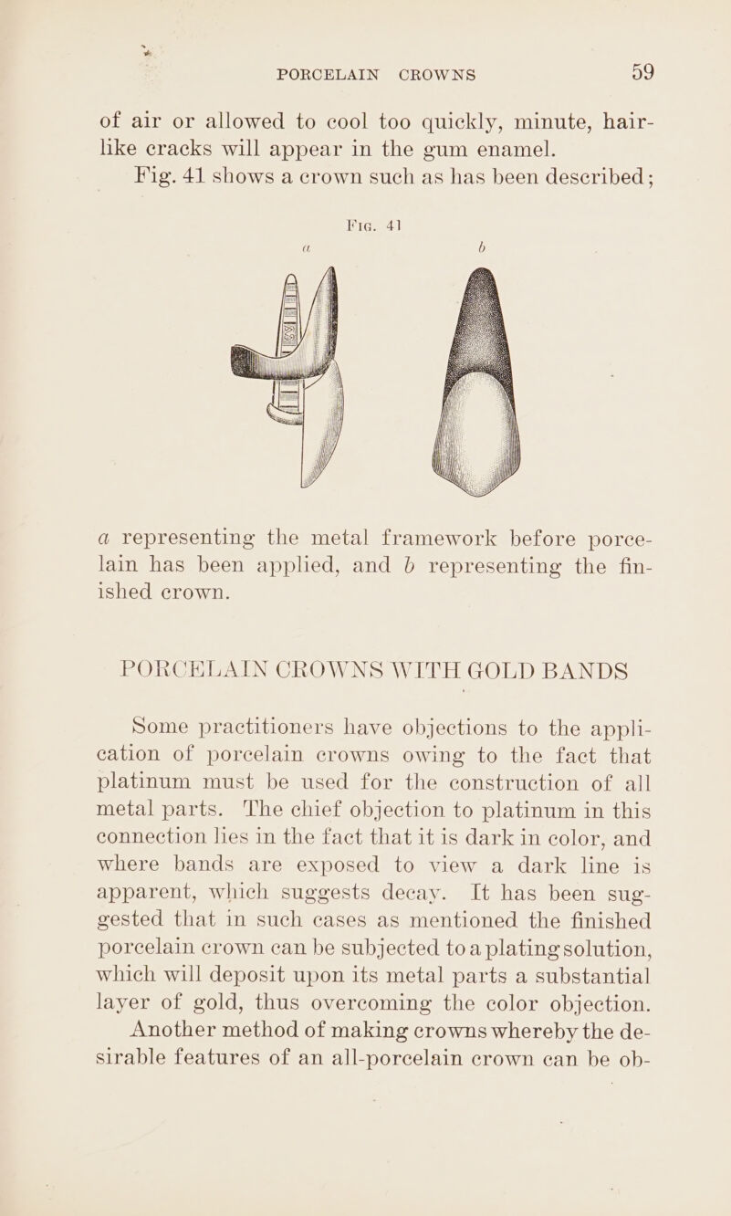of air or allowed to cool too quickly, minute, hair- like cracks will appear in the gum enamel. Fig. 41 shows a crown such as has been described; Ite. 41 a representing the metal framework before porce- lain has been apphed, and b representing the fin- ished crown. PORCELAIN CROWNS WITH GOLD BANDS Some practitioners have objections to the appli- cation of porcelain crowns owing to the fact that platinum must be used for the construction of all metal parts. The chief objection to platinum in this connection lies in the fact that it is dark in color, and where bands are exposed to view a dark line is apparent, which suggests decay. It has been sug- gested that in such cases as mentioned the finished porcelain crown can be subjected toa plating solution, which will deposit upon its metal parts a substantial layer of gold, thus overcoming the color objection. Another method of making crowns whereby the de- sirable features of an all-porcelain crown can be ob-