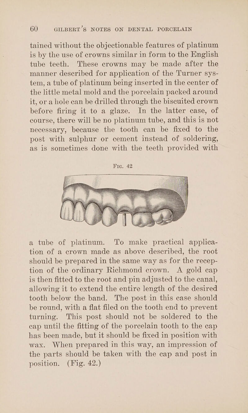 tained without the objectionable features of platinum is by the use of crowns similar in form to the English tube teeth. These crowns may be made after the manner described for application of the Turner sys- tem, a tube of platinum being inserted in the center of the little metal mold and the porcelain packed around it, or a hole can be drilled through the biscuited crown before firing it to a glaze. In the latter case, of course, there will be no platinum tube, and this is not necessary, because the tooth can be fixed to the post with sulphur or cement instead of soldering, as is sometimes done with the teeth provided with HiGss42 _ wid a tube of platinum. To make practical applica- tion of a crown made as above described, the root should be prepared in the same way as for the recep- tion of the ordinary Richmond crown. A gold cap is then fitted to the root and pin adjusted to the canal, allowing it to extend the entire length of the desired tooth below the band. The post in this case should be round, with a flat filed on the tooth end to prevent turning. This post should not be soldered to the eap until the fitting of the porcelain tooth to the cap has been made, but it should be fixed in position with wax. When prepared in this way, an impression of the parts should be taken with the cap and post in position. (Fig. 42.)