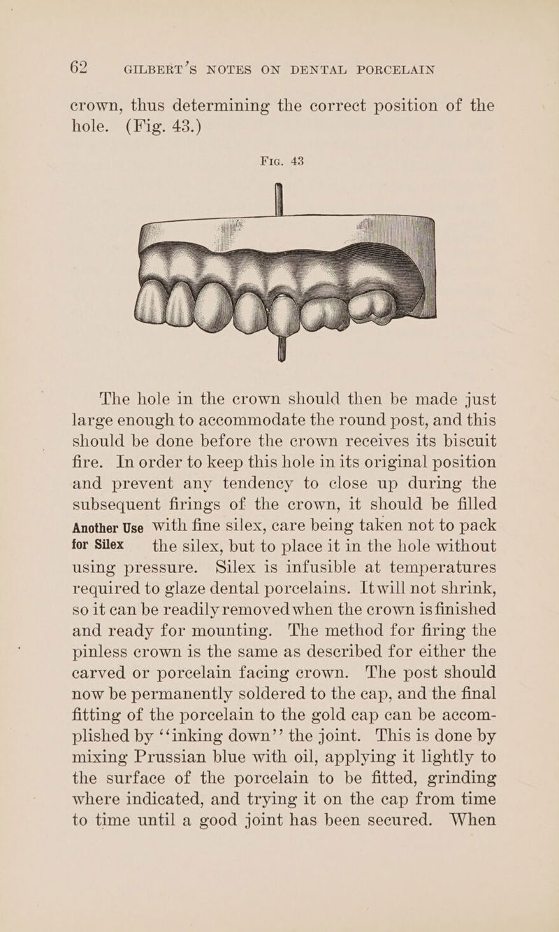 crown, thus determining the correct position of the hole. (Fig. 43.) The hole in the crown should then be made just large enough to accommodate the round post, and this should be done before the crown receives its biscuit fire. In order to keep this hole in its original position and prevent any tendency to close up during the subsequent firings of the crown, it should be filled Another Use With fine silex, care being taken not to pack for Silex the silex, but to place it in the hole without using pressure. Silex is infusible at temperatures required to glaze dental porcelains. Itwill not shrink, so it can be readily removed when the crown is finished and ready for mounting. The method for firing the pinless crown is the same as described for either the carved or porcelain facing crown. The post should now be permanently soldered to the cap, and the final fitting of the porcelain to the gold cap can be accom- plished by ‘‘inking down’’ the joint. This is done by mixing Prussian blue with oil, applying it lightly to the surface of the porcelain to be fitted, grinding where indicated, and trying it on the cap from time to time until a good joint has been secured. When