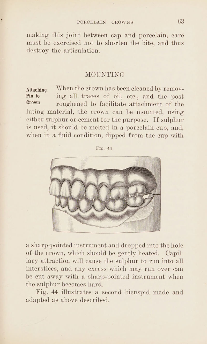 making this jot between cap and porcelain, care must be exercised not to shorten the bite, and thus destroy the articulation. MOUNTING Attaching When the crown has been cleaned by remov- Pin to ing all traces of oil, etc., and the post Crown roughened to facilitate attachment of the luting material, the crown can be mounted, using either sulphur or cement for the purpose. If sulphur is used, it should be melted in a porcelain cup, and, when in a fluid condition, dipped from the cup with Fic. 44 (i ||| HHI HU | \ I a Sharp-pointed instrument and dropped into the hole of the crown, which should be gently heated. Capil- lary attraction will cause the sulphur to run into all interstices, and any excess which may run over can be cut away with a sharp-pointed instrument when the sulphur becomes hard. Fig. 44 illustrates a second bicuspid made and adapted as above described. HI Tu