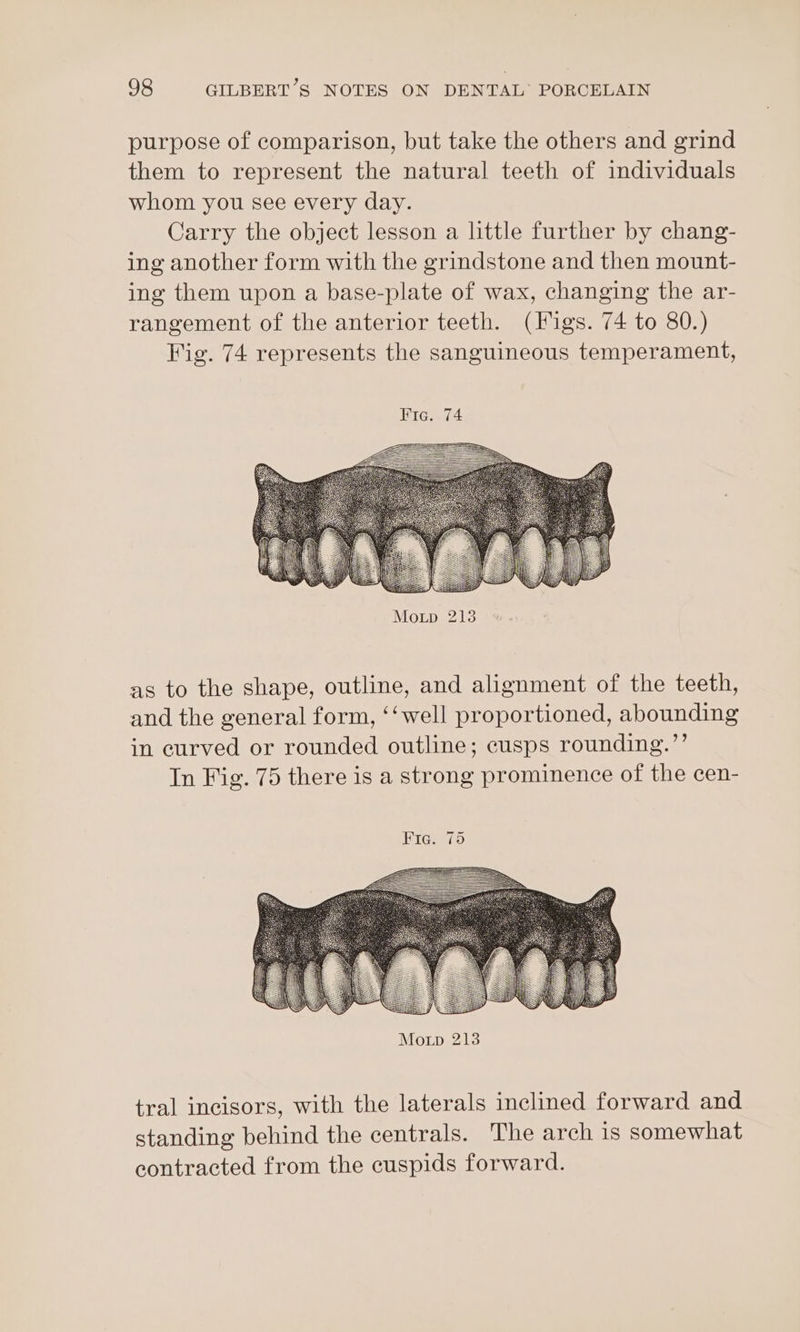purpose of comparison, but take the others and grind them to represent the natural teeth of individuals whom you see every day. Carry the object lesson a little further by chang- ing another form with the grindstone and then mount- ing them upon a base-plate of wax, changing the ar- rangement of the anterior teeth. (igs. 74 to 80.) Wig. 74 represents the sanguineous temperament, Fre. 74 as to the shape, outline, and alignment of the teeth, and the general form, ‘‘well proportioned, abounding in curved or rounded outline; cusps rounding.’’ In Fig. 75 there is a strong prominence of the cen- tral incisors, with the laterals inclined forward and standing behind the centrals. The arch is somewhat contracted from the cuspids forward.