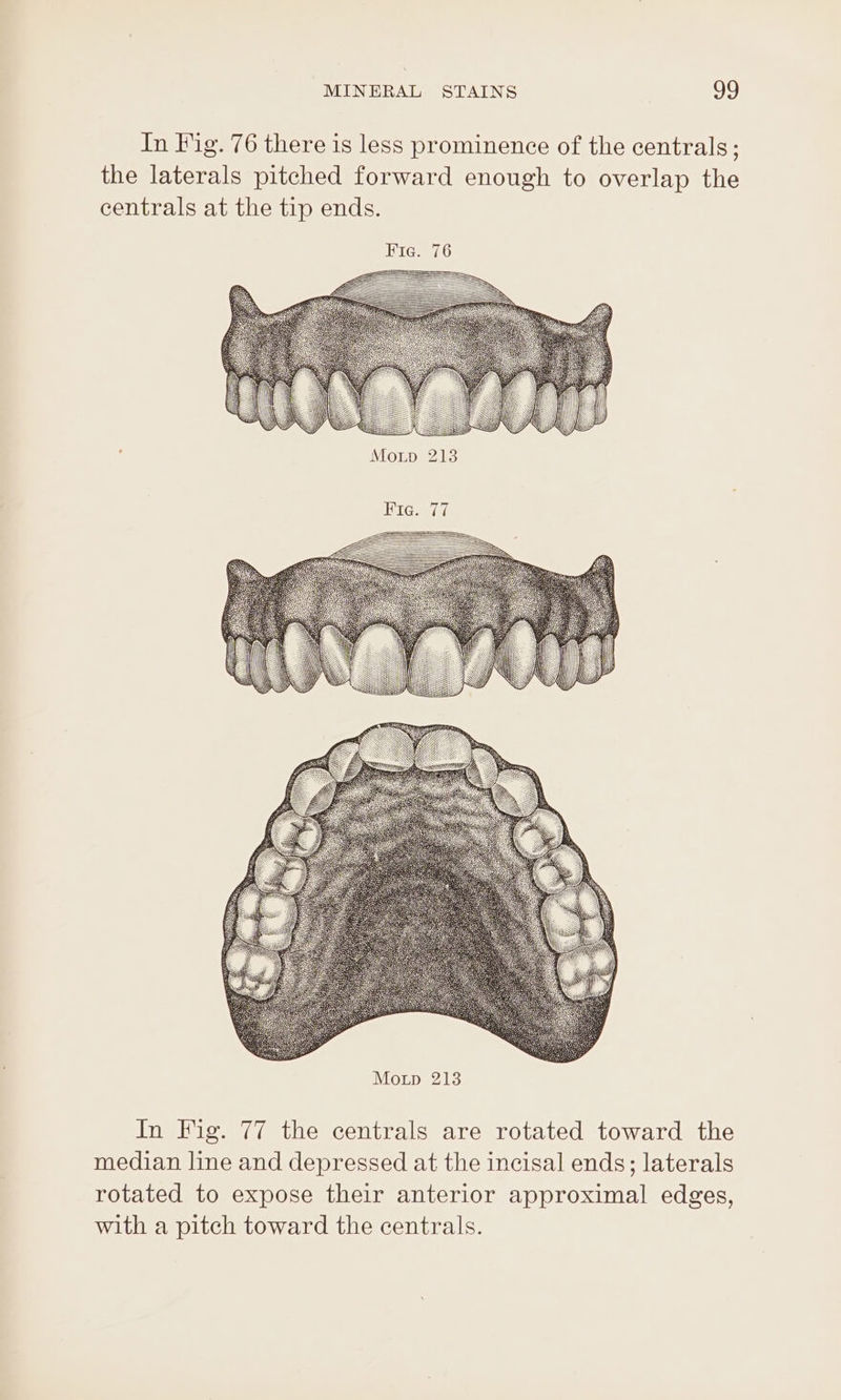 In Fig. 76 there is less prominence of the centrals ; the laterals pitched forward enough to overlap the centrals at the tip ends. QU In Fig. 77 the centrals are rotated toward the median line and depressed at the incisal ends; laterals rotated to expose their anterior approximal edges, with a pitch toward the centrals.