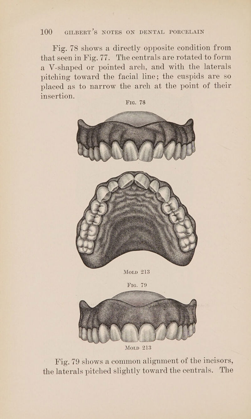 Fig. 78 shows a directly opposite condition from that seen in Fig. 77. The centrals are rotated to form a V-shaped or pointed arch, and with the laterals pitching toward the facial line; the cuspids are so placed as to narrow the arch at the point of their insertion. Pia? 78 Fie. 79 App php” Mop 213 Fig. 79 shows a common alignment of the incisors, the laterals pitched slightly toward the centrals. The