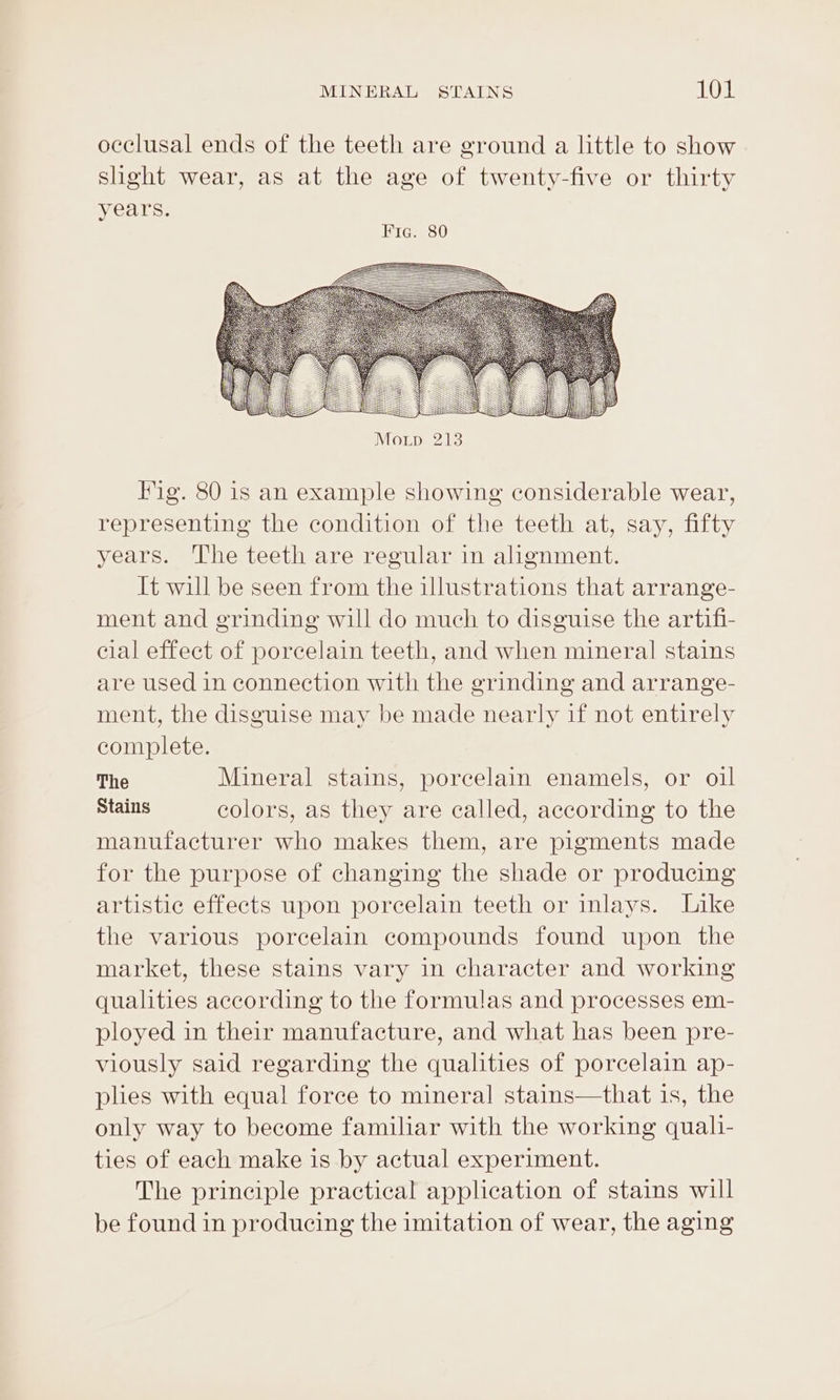 occlusal ends of the teeth are ground a little to show slight wear, as at the age of twenty-five or thirty years. Fic. 80 Fig. 80 is an example showing considerable wear, representing the condition of the teeth at, say, fifty years. The teeth are regular in alignment. It will be seen from the illustrations that arrange- ment and grinding will do much to disguise the artifi- cial effect of porcelain teeth, and when mineral stains are used in connection with the grinding and arrange- ment, the disguise may be made nearly if not entirely complete. The Mineral stains, porcelain enamels, or oil Stains colors, as they are called, according to the manufacturer who makes them, are pigments made for the purpose of changing the shade or producing artistic effects upon porcelain teeth or inlays. Like the various porcelain compounds found upon the market, these stains vary in character and working qualities according to the formulas and processes em- ployed in their manufacture, and what has been pre- viously said regarding the qualities of porcelain ap- plies with equal force to mineral stains—that is, the only way to become familiar with the working quali- ties of each make is by actual experiment. The principle practical application of stains will be found in producing the imitation of wear, the aging