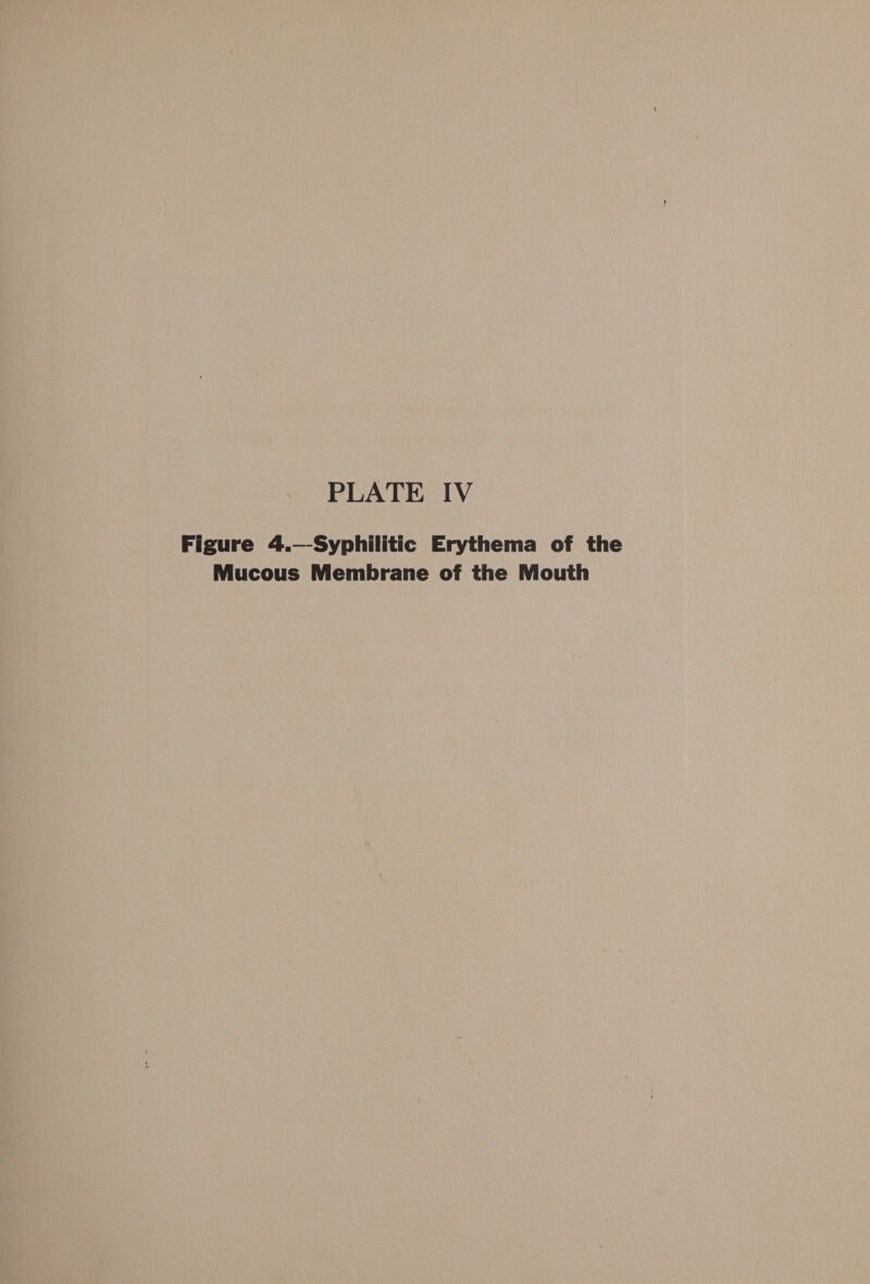 Figure 4.—-Syphilitic Erythema of the Mucous Membrane of the Mouth