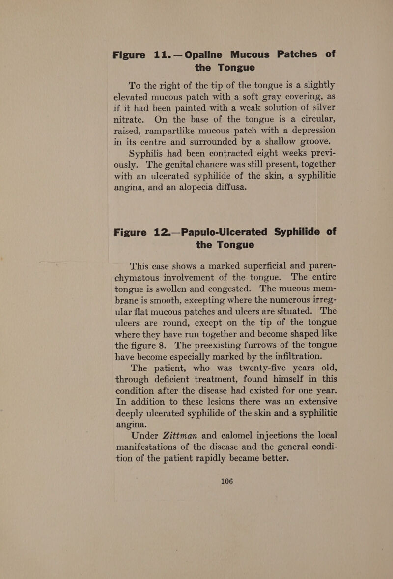 Figure 11.—Opaline Mucous Patches of the Tongue To the right of the tip of the tongue is a slightly elevated mucous patch with a soft gray covering, as if it had been painted with a weak solution of silver nitrate. On the base of the tongue is a circular, raised, rampartlike mucous patch with a depression in its centre and surrounded by a shallow groove. Syphilis had been contracted eight weeks previ- ously. The genital chancre was still present, together with an ulcerated syphilide of the skin, a syphilitic angina, and an alopecia diffusa. Figure 12.—Papulo-Ulcerated Syphilide of the Tongue This case shows a marked superficial and paren- chymatous involvement of the tongue. The entire tongue is swollen and congested. The mucous mem- brane is smooth, excepting where the numerous irreg- ular flat mucous patches and ulcers are situated. The ulcers are round, except on the tip of the tongue where they have run together and become shaped like the figure 8. The preexisting furrows of the tongue have become especially marked by the infiltration. The patient, who was twenty-five years old, through deficient treatment, found himself in this condition after the disease had existed for one year. In addition to these lesions there was an extensive deeply ulcerated syphilide of the skin and a syphilitic angina. Under Zittman and calomel injections the local manifestations of the disease and the general condi- tion of the patient rapidly became better.