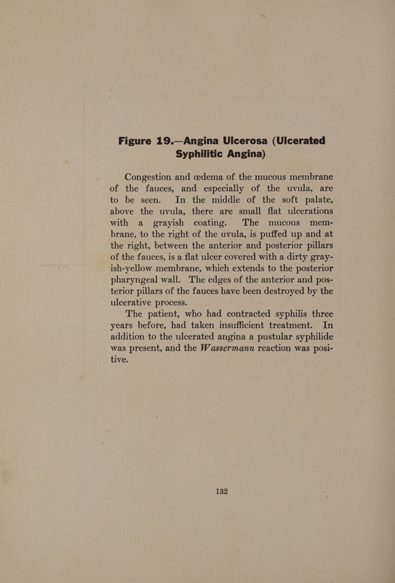 Figure 19.—Angina Ulcerosa (Ulcerated Syphilitic Angina) Congestion and cedema of the mucous membrane of the fauces, and especially of the uvula, are to be seen. In the middle of the soft palate, above the uvula, there are small flat ulcerations with a _ grayish coating. The mucous mem- brane, to the right of the uvula, is puffed up and at the right, between the anterior and posterior pillars of the fauces, is a flat ulcer covered with a dirty gray- ish-yellow membrane, which extends to the posterior pharyngeal wall. The edges of the anterior and pos- terior pillars of the fauces have been destroyed by the ulcerative process. ' The patient, who had concen syphilis three years before, had taken insufficient treatment. In addition to the ulcerated angina a pustular syphilide was present, and the Wassermann reaction was posi- tive.