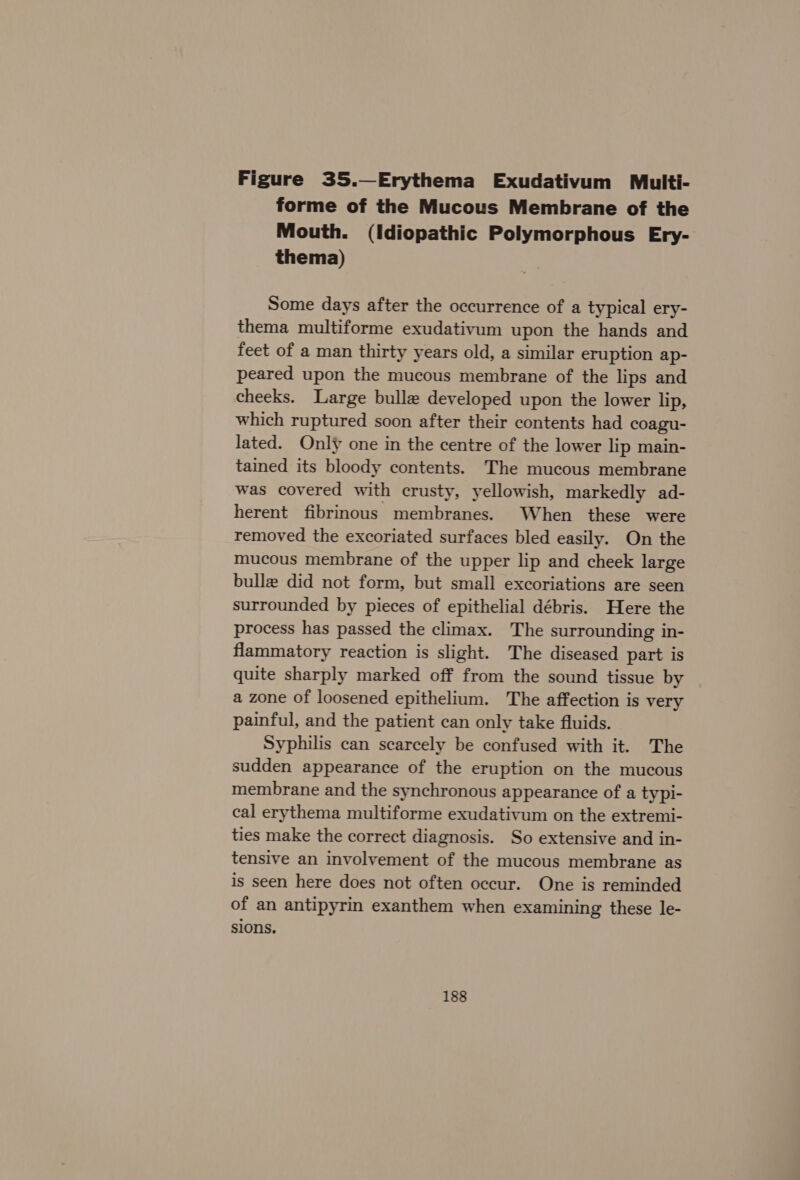 Figure 35.—Erythema Exudativum Multi- forme of the Mucous Membrane of the Mouth. (Idiopathic Polymorphous Ery- thema) Some days after the occurrence of a typical ery- thema multiforme exudativum upon the hands and feet of a man thirty years old, a similar eruption ap- peared upon the mucous membrane of the lips and cheeks. Large bulle developed upon the lower lip, which ruptured soon after their contents had coagu- lated. Only one in the centre of the lower lip main- tained its bloody contents. The mucous membrane was covered with crusty, yellowish, markedly ad- herent fibrinous membranes. When these were removed the excoriated surfaces bled easily. On the mucous membrane of the upper lip and cheek large bulla did not form, but small excoriations are seen surrounded by pieces of epithelial débris. Here the process has passed the climax. The surrounding in- flammatory reaction is slight. The diseased part is quite sharply marked off from the sound tissue by a zone of loosened epithelium. The affection is very painful, and the patient can only take fluids. Syphilis can scarcely be confused with it. The sudden appearance of the eruption on the mucous membrane and the synchronous appearance of a typi- cal erythema multiforme exudativum on the extremi- ties make the correct diagnosis. So extensive and in- tensive an involvement of the mucous membrane as is seen here does not often occur. One is reminded of an antipyrin exanthem when examining these le- sions.
