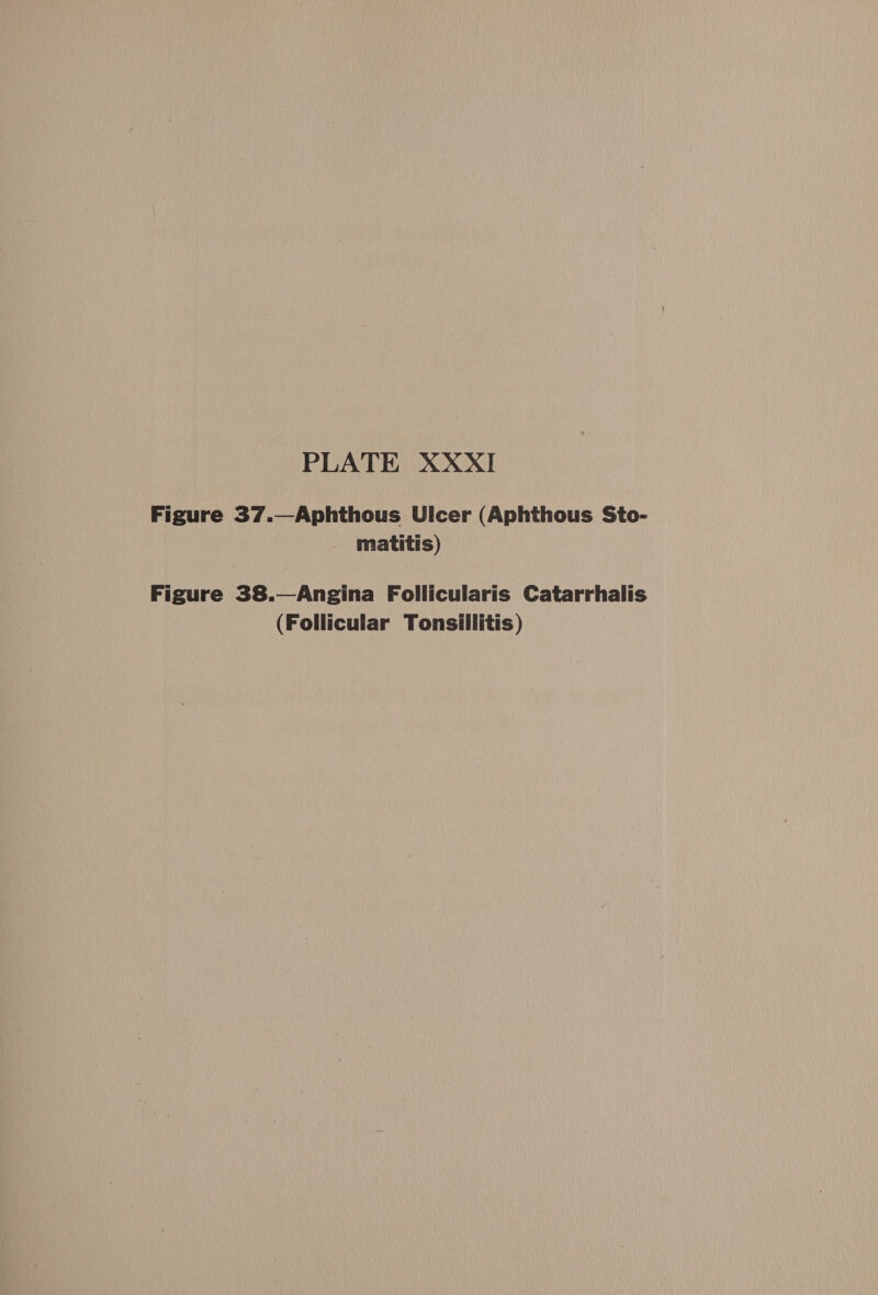 Figure 37.—Aphthous Ulcer (Aphthous Sto- matitis) Figure 38.—Angina Follicularis Catarrhalis (Follicular Tonsillitis)