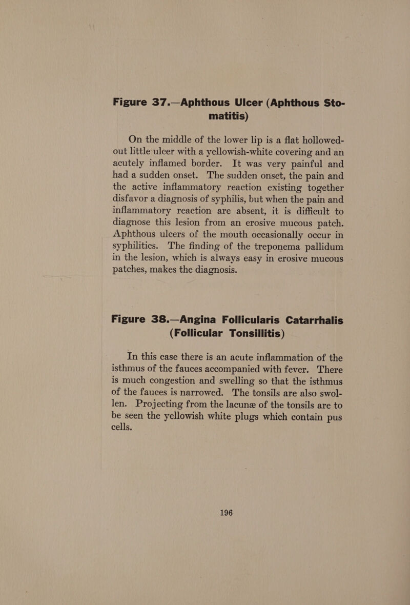 Figure 37.—Aphthous Ulcer (Aphthous Sto- matitis) On the middle of the lower lip is a flat hollowed- out little ulcer with a yellowish-white covering and an acutely inflamed border. It was very painful and had a sudden onset. The sudden onset, the pain and the active inflammatory reaction existing together disfavor a diagnosis of syphilis, but when the pain and inflammatory reaction are absent, it is difficult to diagnose this lesion from an erosive mucous patch. Aphthous ulcers of the mouth occasionally occur in syphilitics. The finding of the treponema pallidum in the lesion, which is always easy in erosive mucous patches, makes the diagnosis. Figure 38.—Angina Follicularis Catarrhalis (Follicular Tonsillitis) In this case there is an acute inflammation of the isthmus of the fauces accompanied with fever. There is much congestion and swelling so that the isthmus of the fauces is narrowed. The tonsils are also swol- len. Projecting from the lacunz of the tonsils are to be seen the yellowish white plugs which contain pus cells.