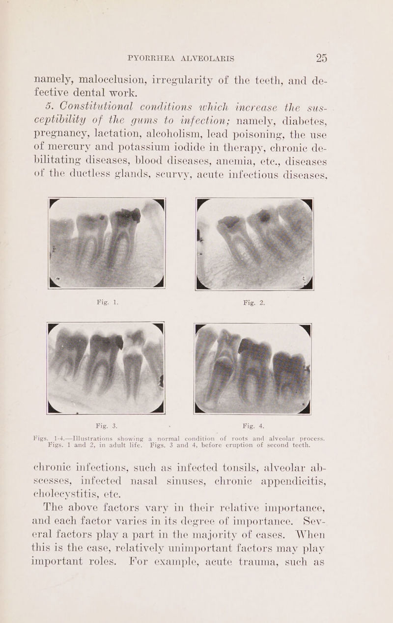 namely, malocclusion, irregularity of the teeth, and de- fective dental work. 5. Constitutional conditions which increase the sus- - ceptibility of the gums to infection; namely, diabetes, pregnancy, lactation, alcoholism, lead poisoning, the use of mercury and potassium iodide in therapy, chronie de- bilitating diseases, blood diseases, anemia, ete., diseases of the ductless glands, scurvy, acute infectious diseases, Eigse lis Bige: 2s Figs. 1-4.—Illustrations showing a normal condition of roots and alveolar process. Figs. 1 and 2, in adult life. Figs. 3 and 4, before eruption of second teeth. chronic infections, such as infected tonsils, alveolar ab- scesses, infected nasal sinuses, chronie appendicitis, cholecystitis, ete. The above factors vary in their relative importance, and each factor varies in its degree of importance. Sev- eral factors play a part in the majority of cases. When this is the case, relatively unimportant factors may play important roles. For example, acute trauma, such as