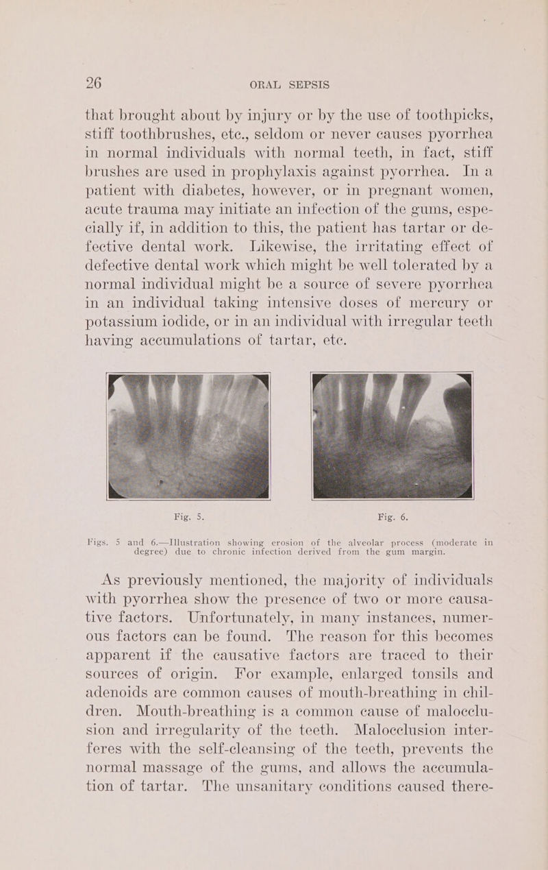 that brought about by injury or by the use of toothpicks, stiff toothbrushes, ete., seldom or never causes pyorrhea in normal individuals with normal teeth, in fact, stiff brushes are used in prophylaxis against pyorrhea. In a patient with diabetes, however, or in pregnant women, acute trauma may initiate an infection of the gums, espe- cially if, in addition to this, the patient has tartar or de- feetive dental work. Likewise, the irritating effect of defective dental work which might be well tolerated by a normal individual might be a source of severe pyorrhea in an individual taking intensive doses of mereury or potassium iodide, or in an individual with irregular teeth having accumulations of tartar, ete. IRS Fig. 6. Fs See Saietih chr fain aiedioas Te ene eae ee As previously mentioned, the majority of individuals with pyorrhea show the presence of two or more causa- tive factors. Unfortunately, in many instances, numer- ous factors can be found. The reason for this becomes apparent if the causative factors are traced to their sources of origin. For example, enlarged tonsils and adenoids are common causes of mouth-breathing in chil- dren. Mouth-breathing is a common cause of malocclu- sion and irregularity of the teeth. Malocclusion inter- feres with the self-cleansing of the teeth, prevents the normal massage of the gums, and allows the accumula- tion of tartar. The unsanitary conditions caused there-