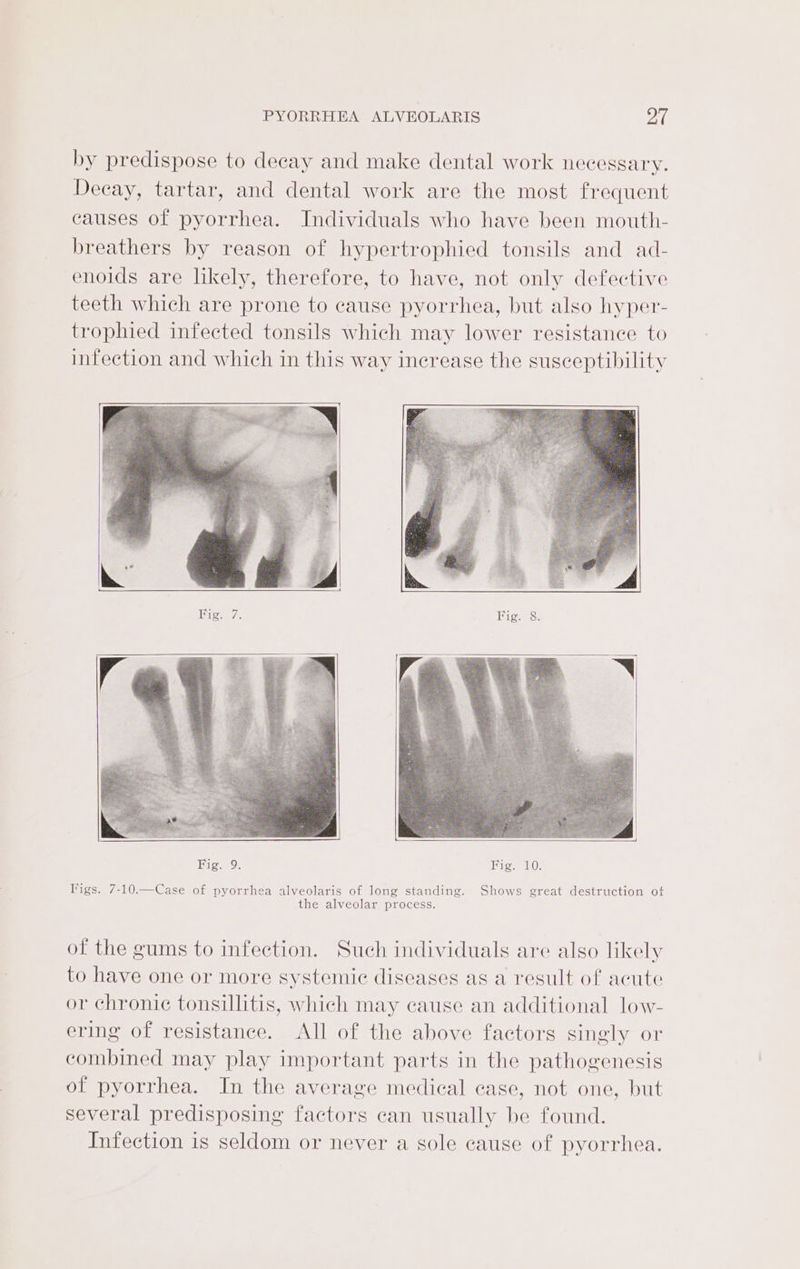 by predispose to decay and make dental work necessary. Decay, tartar, and dental work are the most frequent causes of pyorrhea. Individuals who have been mouth- breathers by reason of hypertrophied tonsils and ad- enoids are likely, therefore, to have, not only defective teeth which are prone to cause pyorrhea, but also hyper- trophied infected tonsils which may lower resistance to infection and which in this way increase the susceptibility Bigs 72 Fig. 8. Fig. 9. Fig. 10. Vigs. 7-10.—Case of pyorrhea alveolaris of long standing. Shows great destruction ot the alveolar process. of the gums to infection. Such individuals are also likely to have one or more systemic diseases as a result of acute or chronic tonsillitis, which may cause an additional low- ering of resistance. All of the above factors singly or combined may play important parts in the pathogenesis of pyorrhea. In the average medical case, not one, but several predisposing factors ean usually be found. Infection is seldom or never a sole cause of pyorrhea.
