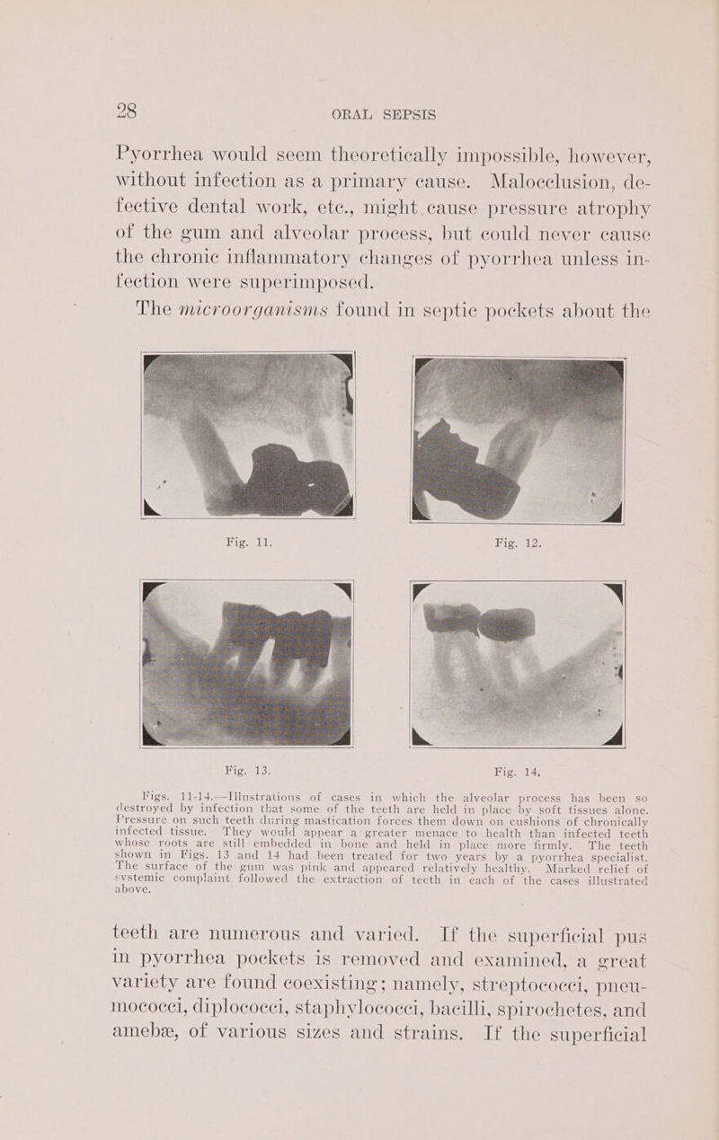 Pyorrhea would seem theoretically impossible, however, without infection as a primary cause. Malocclusion, de- fective dental work, ete., might cause pressure atrophy of the gum and alveolar process, but could never cause the chronic inflammatory changes of pyorrhea unless in- fection were superimposed. The microorganisms found in septie pockets about the Fig; 11, Figs. 11-14.—TIllustrations of cases in which the alveolar process has been so destroyed by infection that some of the teeth are held in place by soft tissues alone. Pressure on such teeth during mastication forces them down on cushions of chronically infected tissue. They would appear a greater menace to health than infected teeth whose roots are still embedded in bone and held in place more firmly. ‘The teeth shown in Figs. 13 and 14 had been treated for two years by a pyorrhea specialist. The surface of the gum was pink and appeared relatively healthy. Marked relief of rougic complaint followed the extraction of teeth in each of the cases illustrated above. teeth are numerous and varied. If the superficial pus in pyorrhea pockets is removed and examined, a great variety are found coexisting; namely, streptococci, pneu- mococel, diplococci, staphylococci, bacilli, spirochetes, and amebe, of various sizes and strains. If the superficial