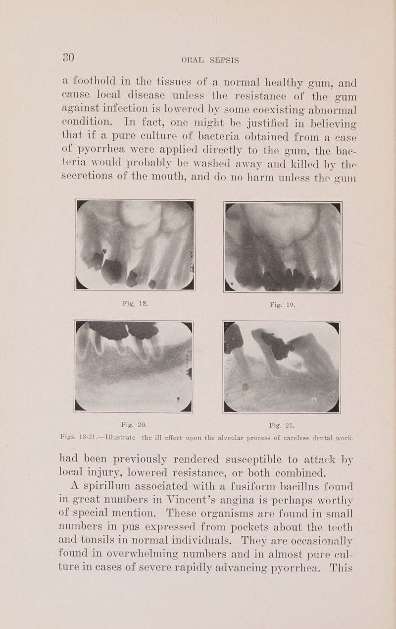 a foothold in the tissues of a normal healthy gum, and cause local disease unless the resistance of the gum against infection is lowered by some coexisting abnormal condition. In fact, one might be justified in believing that if a pure culture of bacteria obtained from a ease of pyorrhea were applied directly to the gum, the bac- teria would probably be washed away and killed by the secretions of the mouth, and do no harm unless the gum Biew hse Fig. 19, Big-720; Figs 21. Figs. 18-21.—Illustrate the ill effect upon the alveolar process of careless dental work. had been previously rendered susceptible to attack by local injury, lowered resistance, or both combined. A spirillum associated with a fusiform bacillus found in great numbers in Vincent’s angina is perhaps worthy of special mention. These organisms are found in small numbers in pus expressed from pockets about the tecth and tonsils in normal individuals. They are occasionally found in overwhelming numbers and in almost pure cul- ture in cases of severe rapidly advancing pyorrhea. This